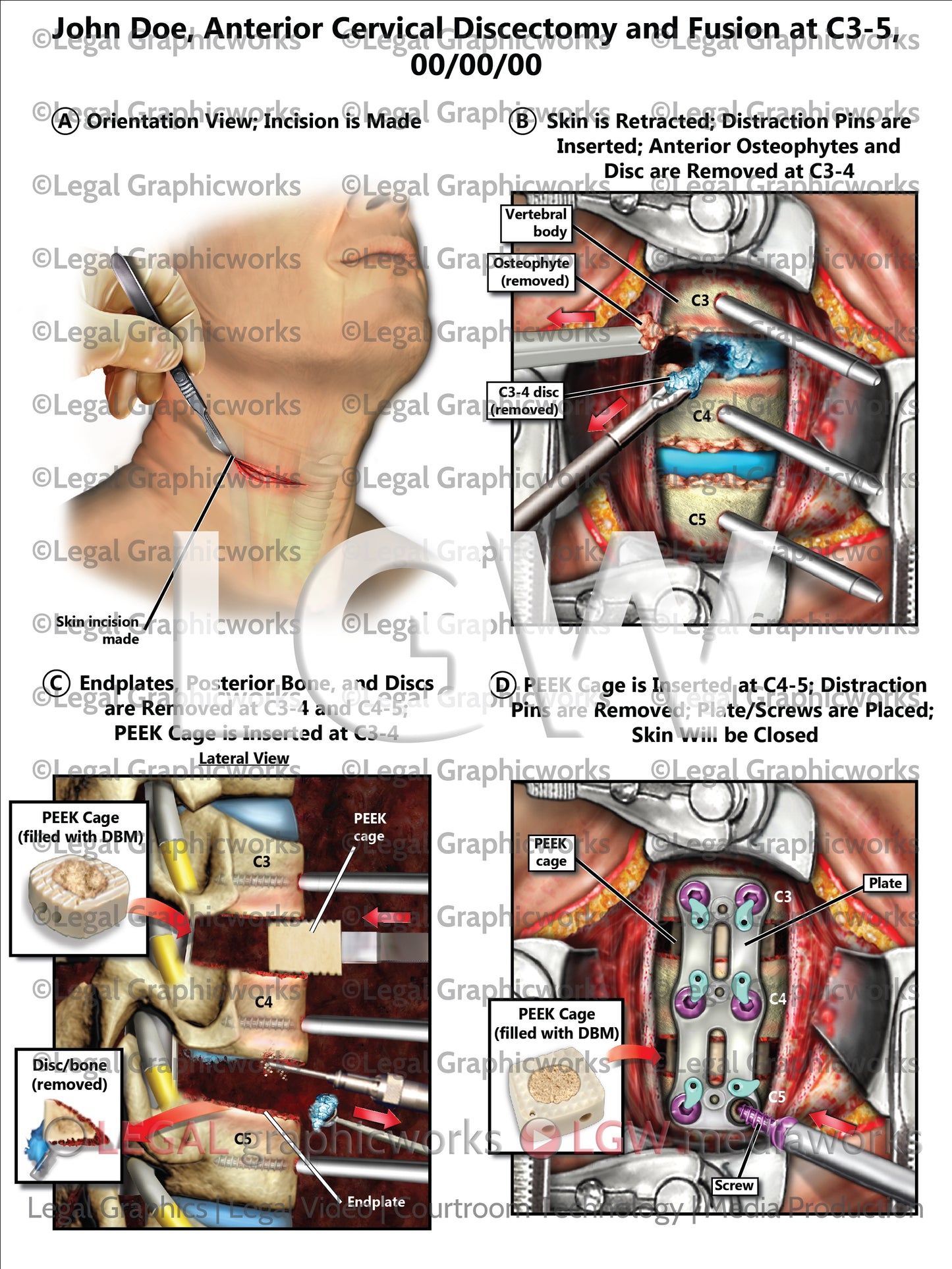 Anterior Cervical Discectomy and Fusion at C3-5