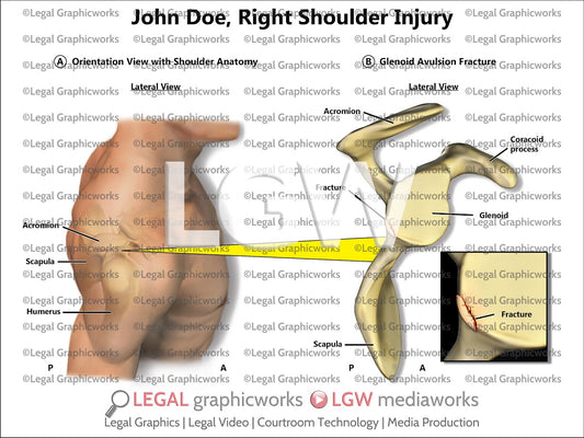 Right Shoulder Injury