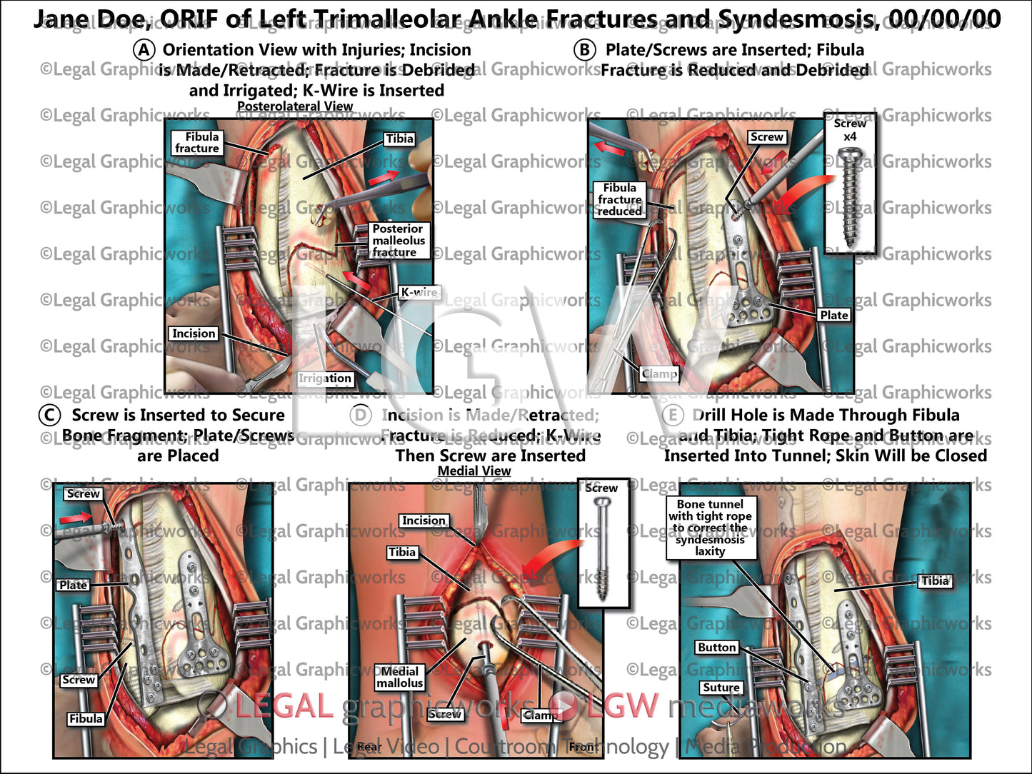 ORIF of Left Trimalleolar Ankle Fractures and Syndesmosis
