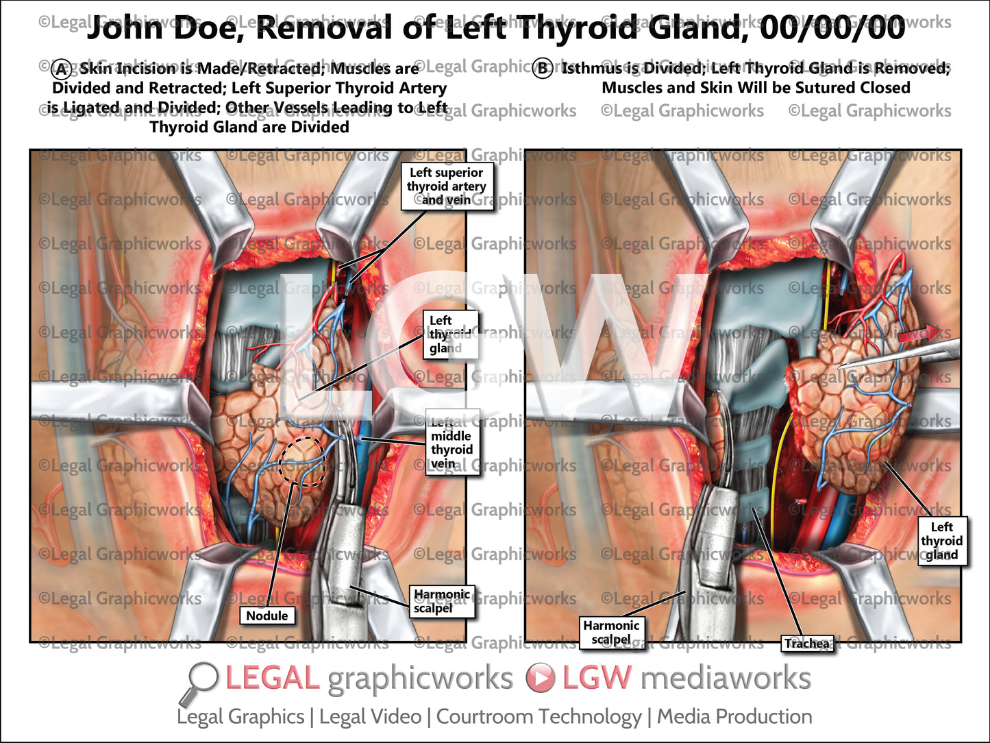 Removal of Left Thyroid Gland
