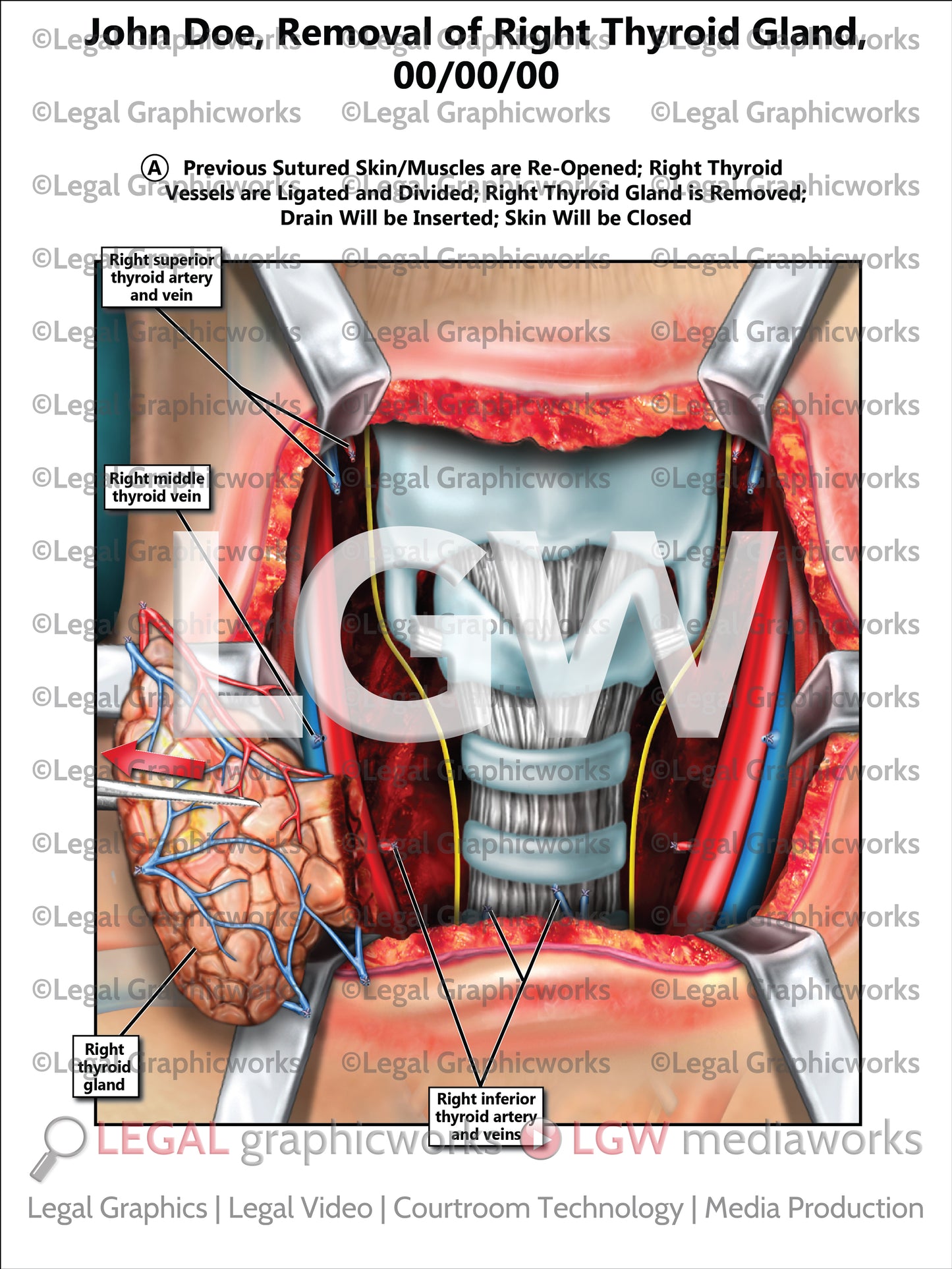 Removal of Right Thyroid Gland