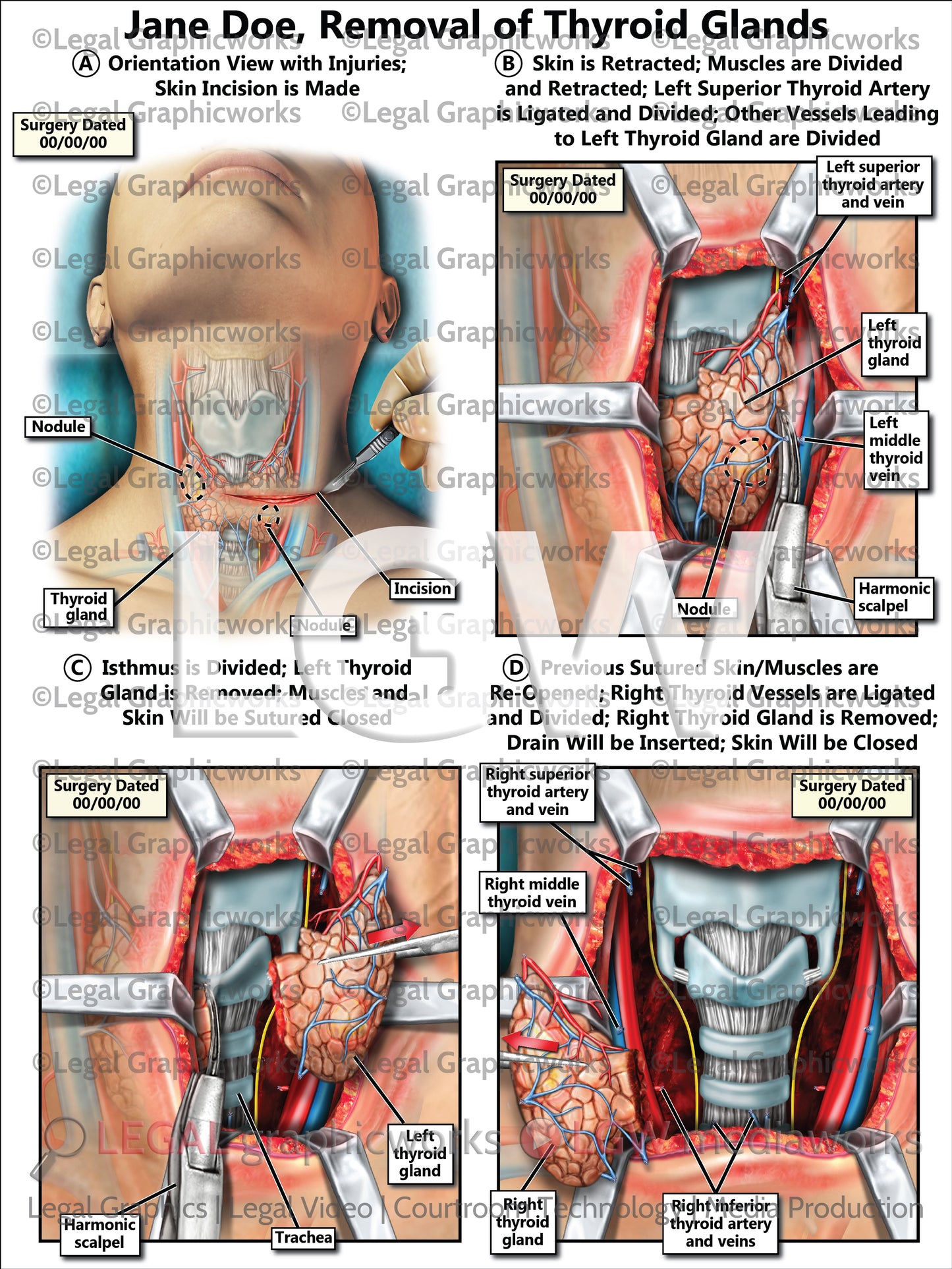 Removal of Thyroid Glands