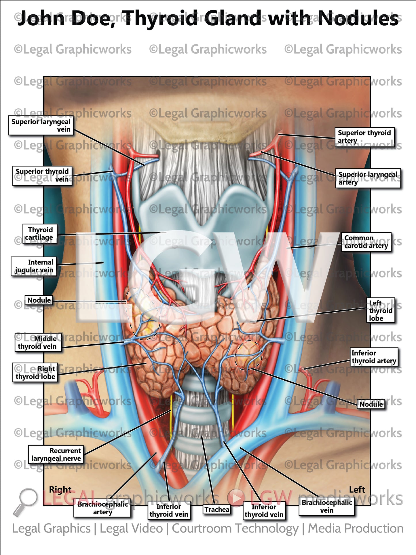 Thyroid Gland with Nodules