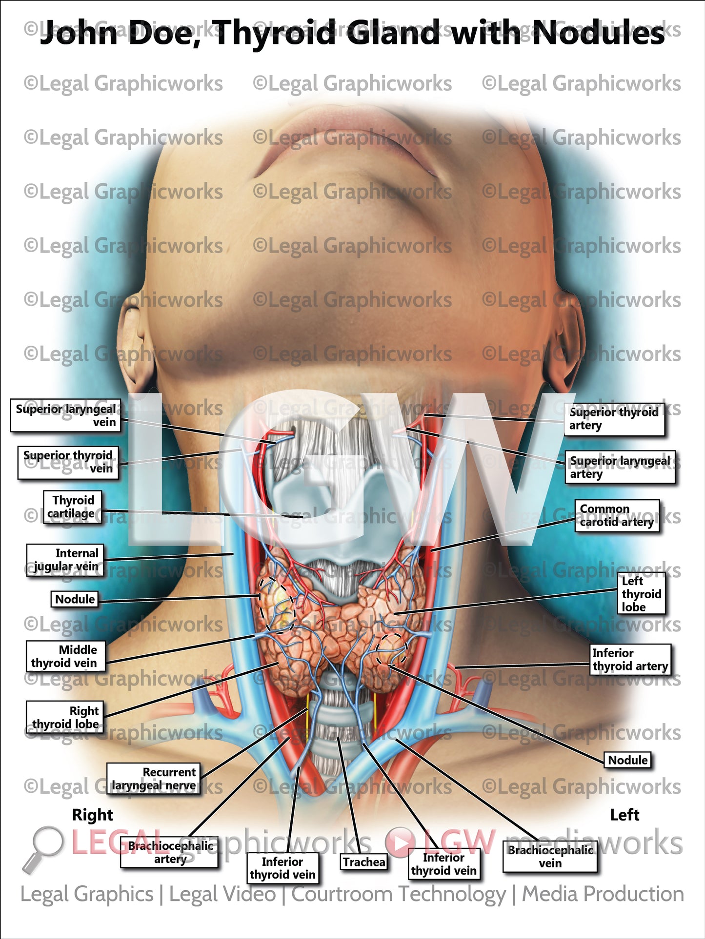 Thyroid Gland with Nodules