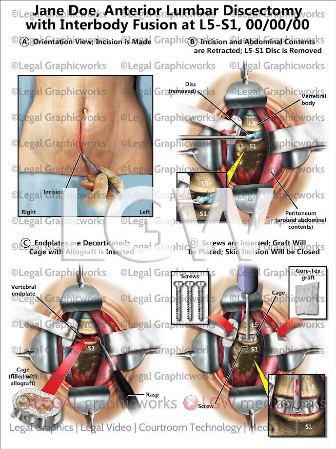 Anterior Lumbar Discectomy with Interbody Fusion at L5-S1