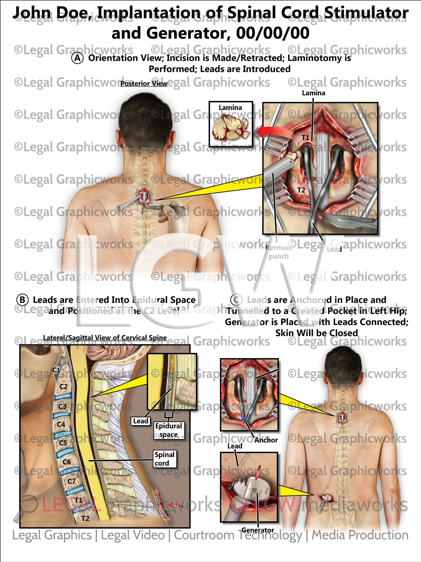 Implantation of Spinal Cord Stimulator and Generator