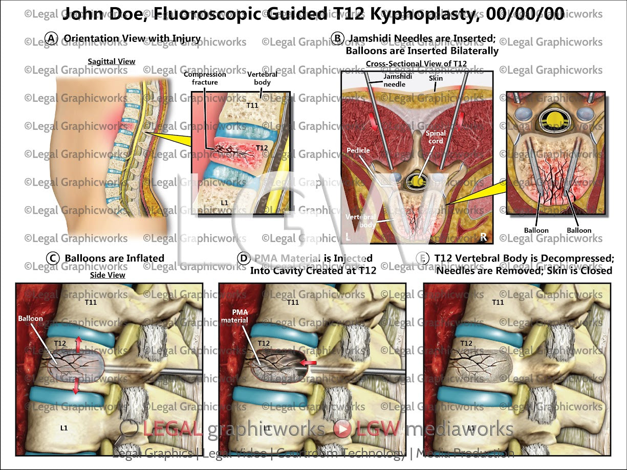 Fluoroscopic Guided T12 Kyphoplasty