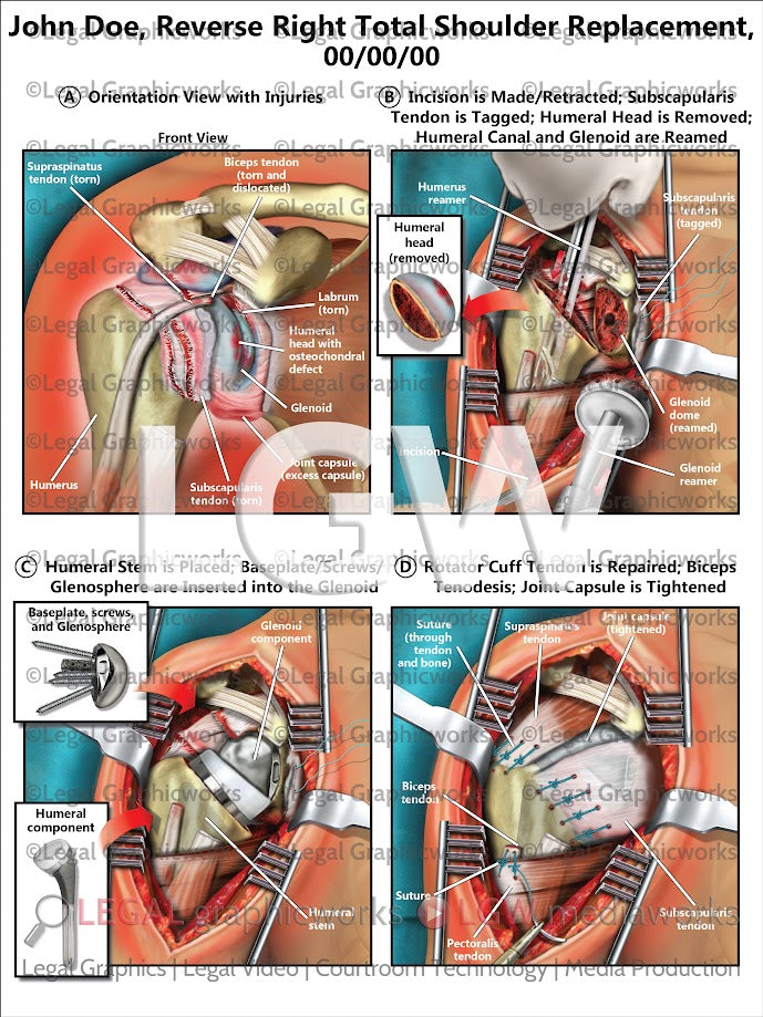 Reverse Right Total Shoulder Replacement