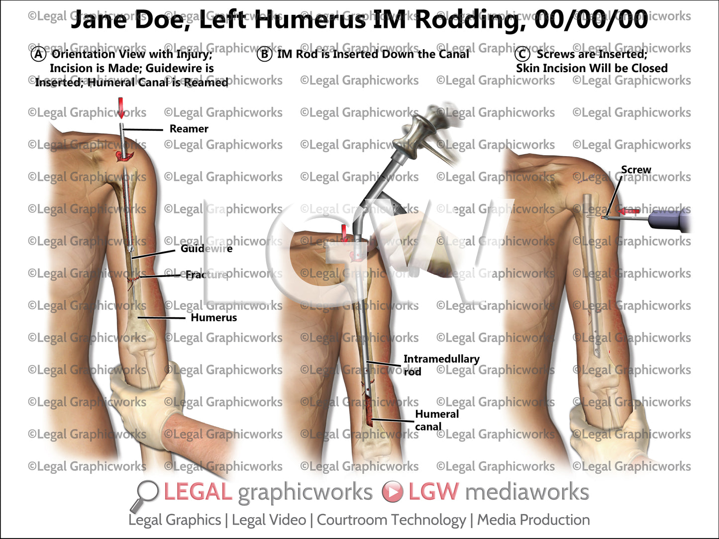 Left Humerus IM Rodding