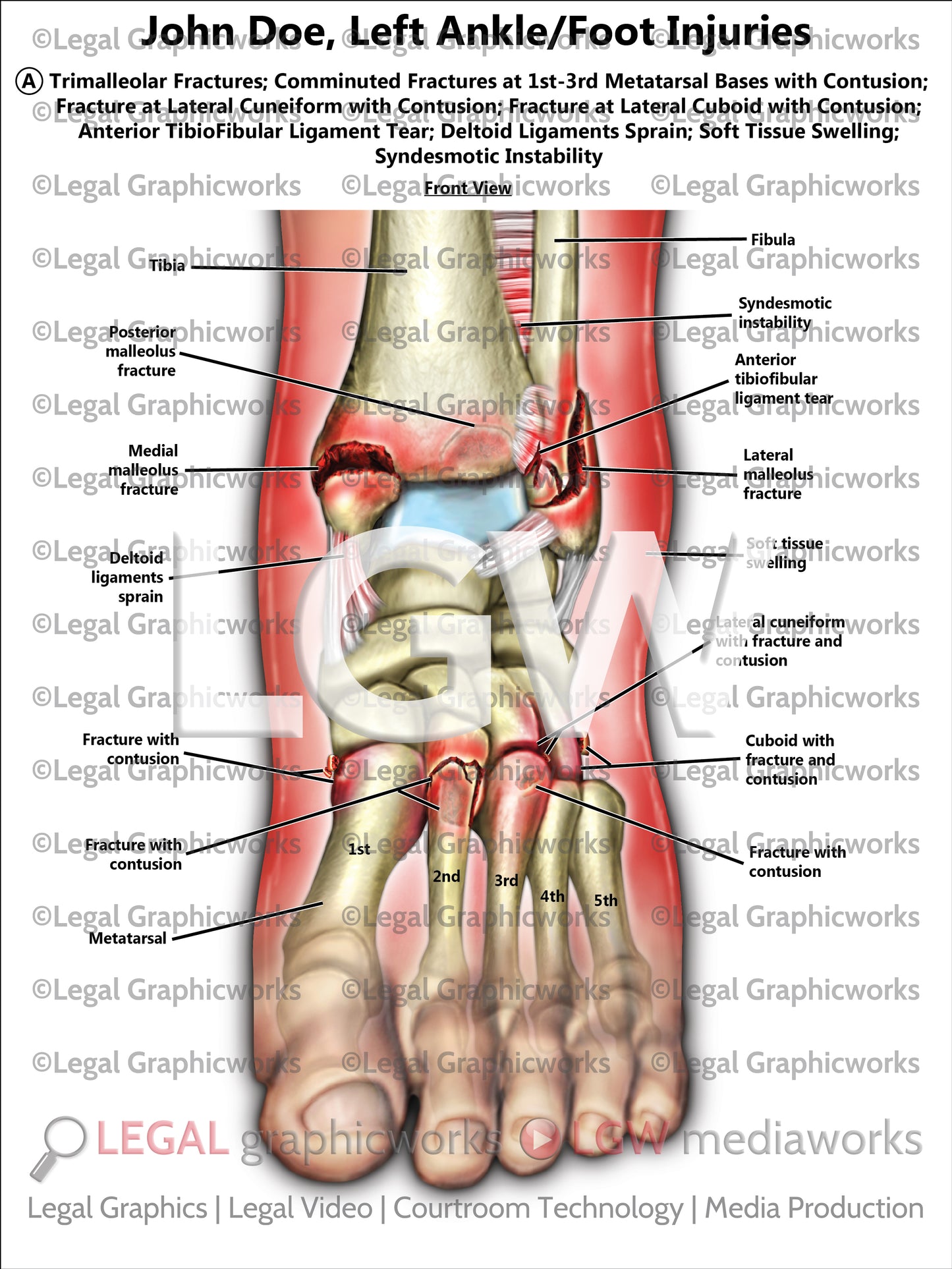 Left Ankle/Foot Injuries