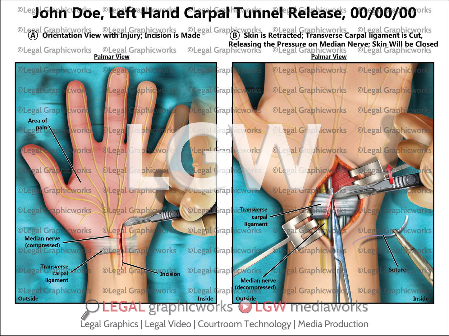 Left Hand Carpal Tunnel Release