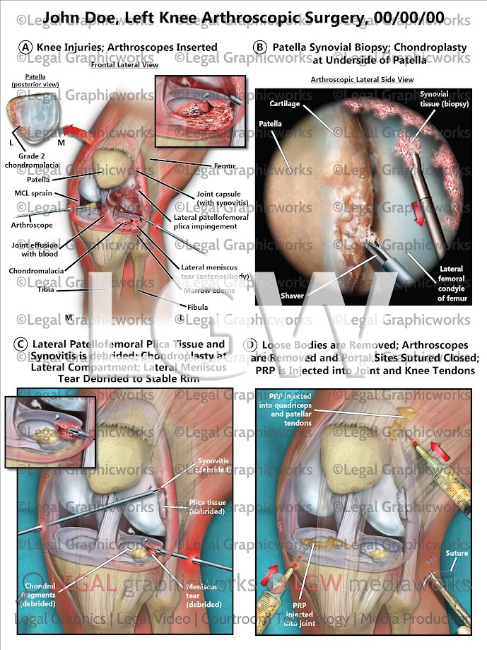 Left Knee Arthroscopic Surgery