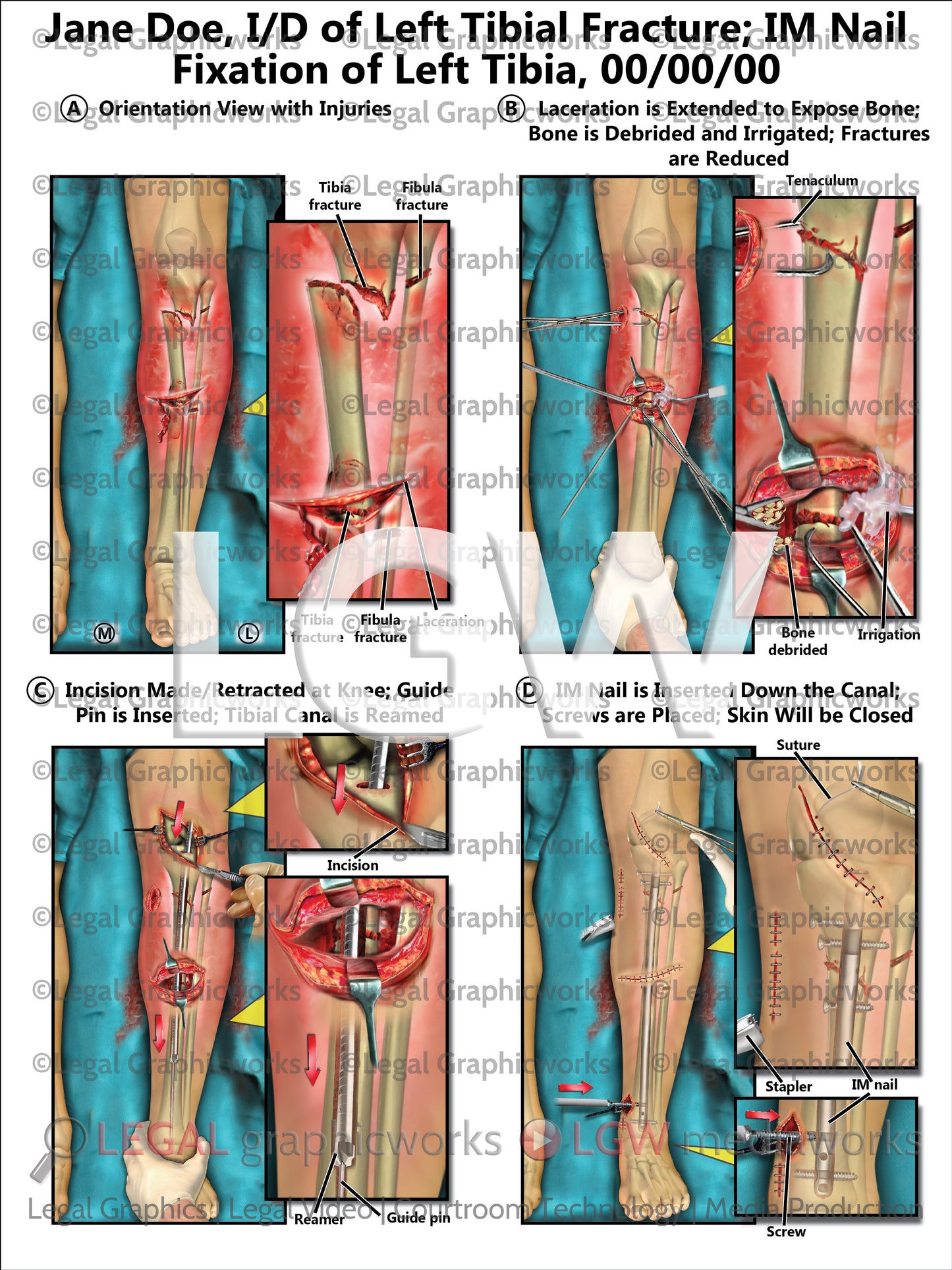 I/D of Left Tibial Fracture; IM Nail Fixation of Left Tibia