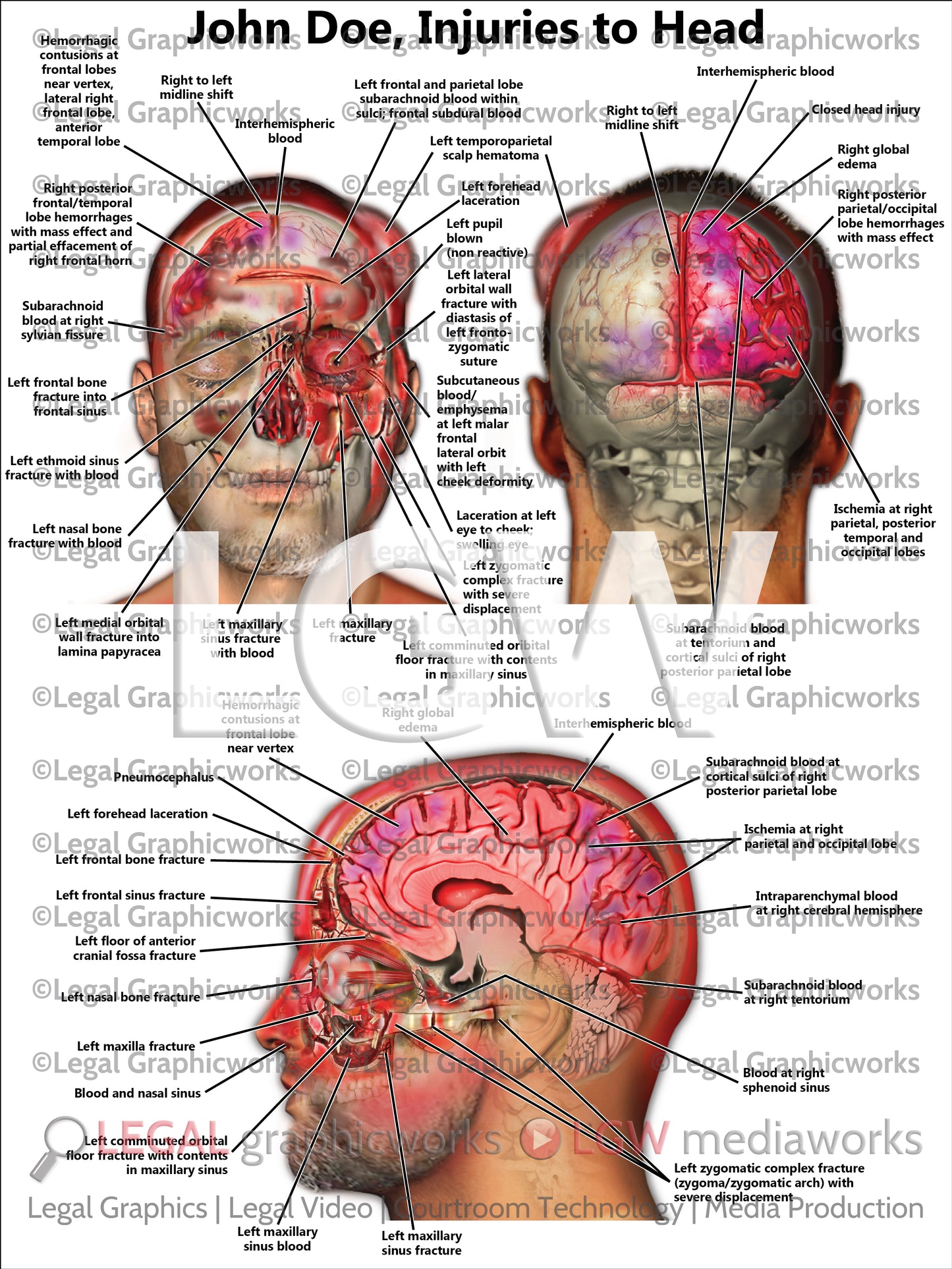 Injuries to Head