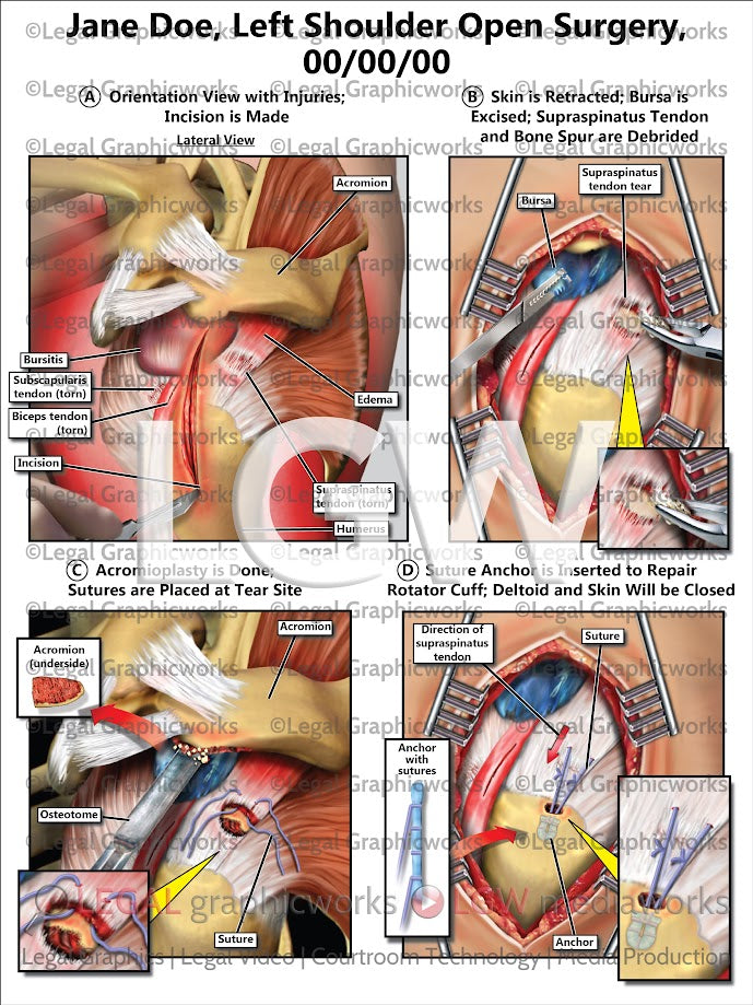 Left Shoulder Open Surgery