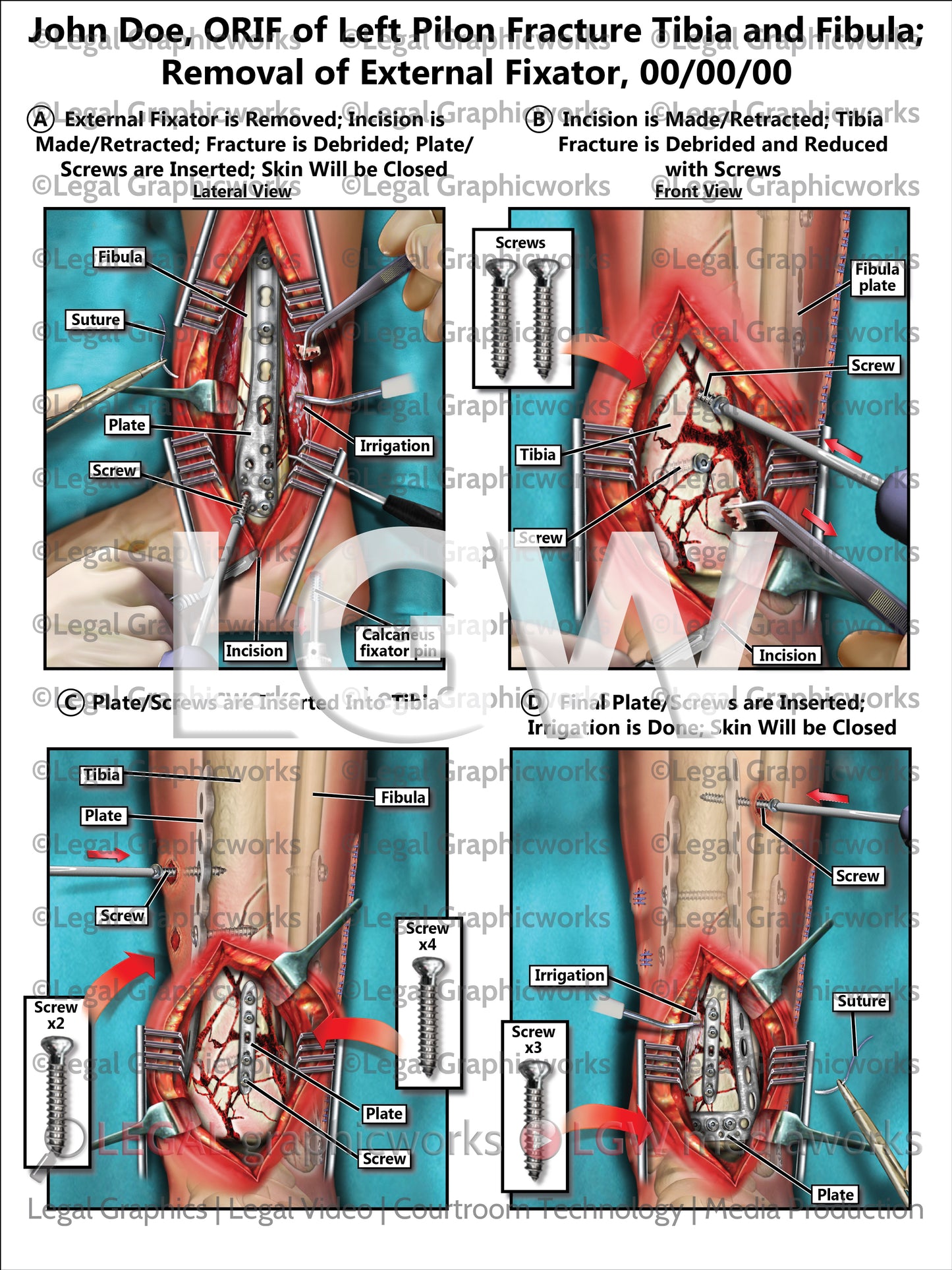 ORIF of Left Pilon Fracture Tibia and Fibula; Removal of External Fixator