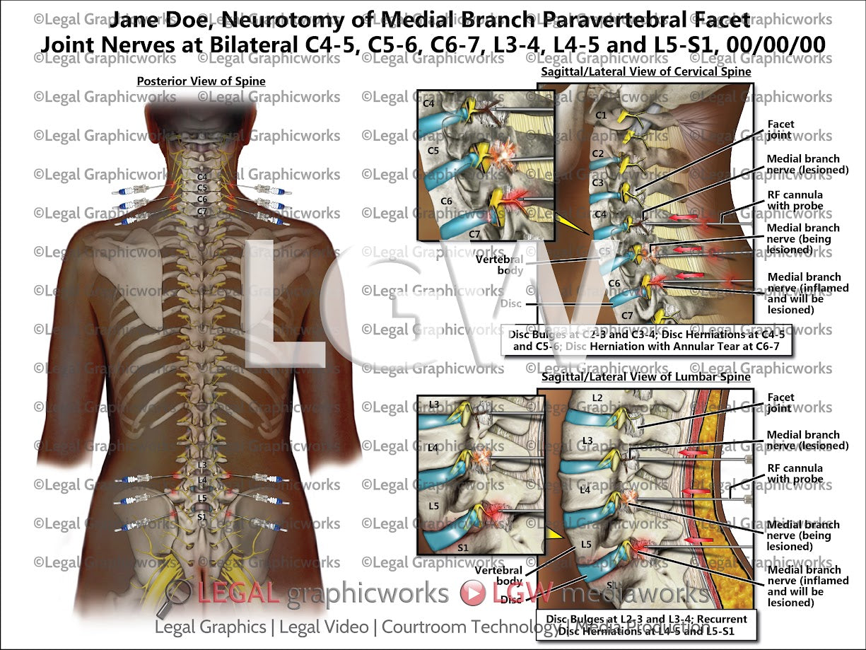 Neurotomy of Medial Branch Paravertebral Facet Joint Nerves at Bilateral C4-5, C5-6, C6-7, L3-4, L4-5, and L5-S1