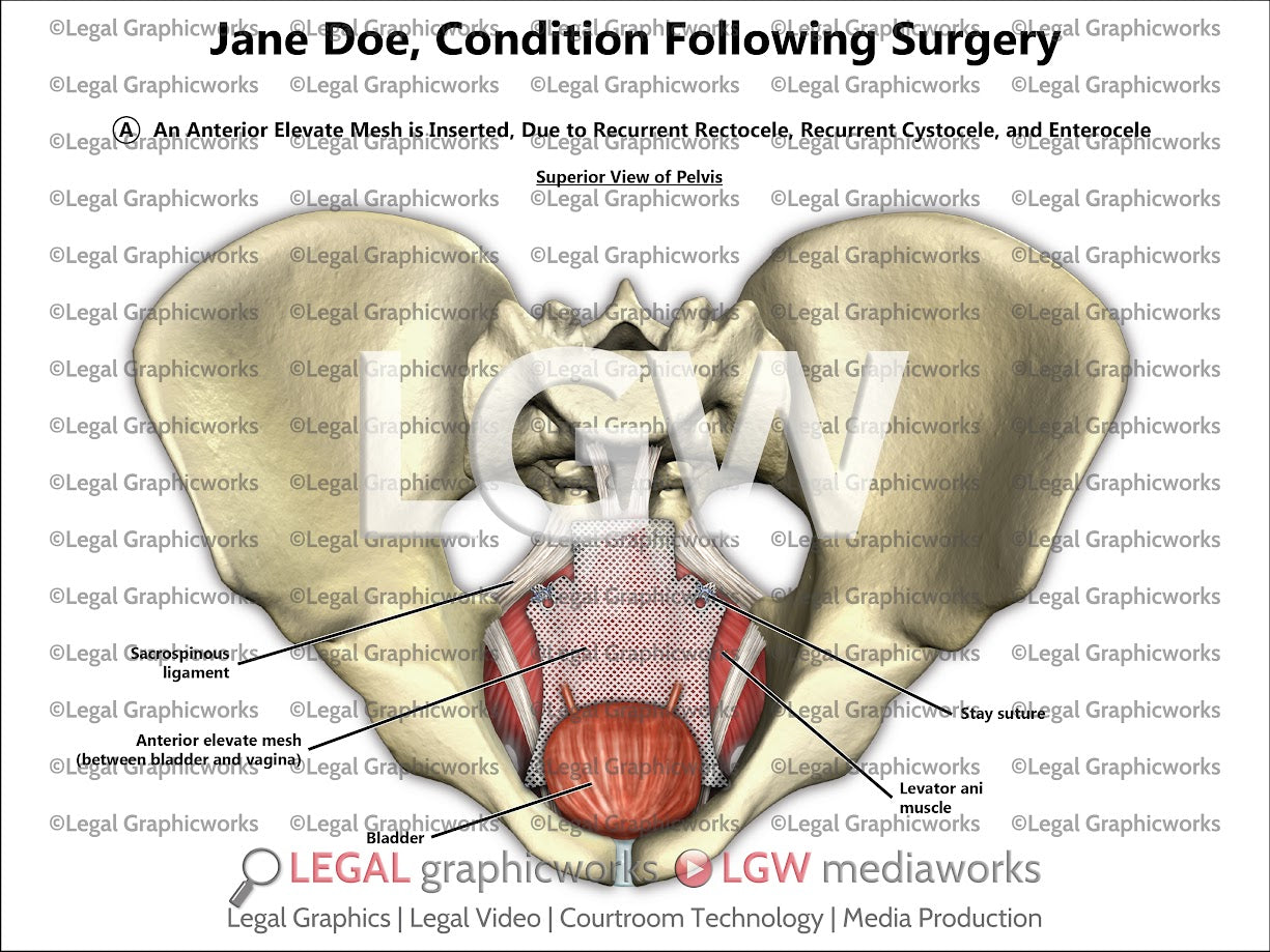 Condition Following Surgery