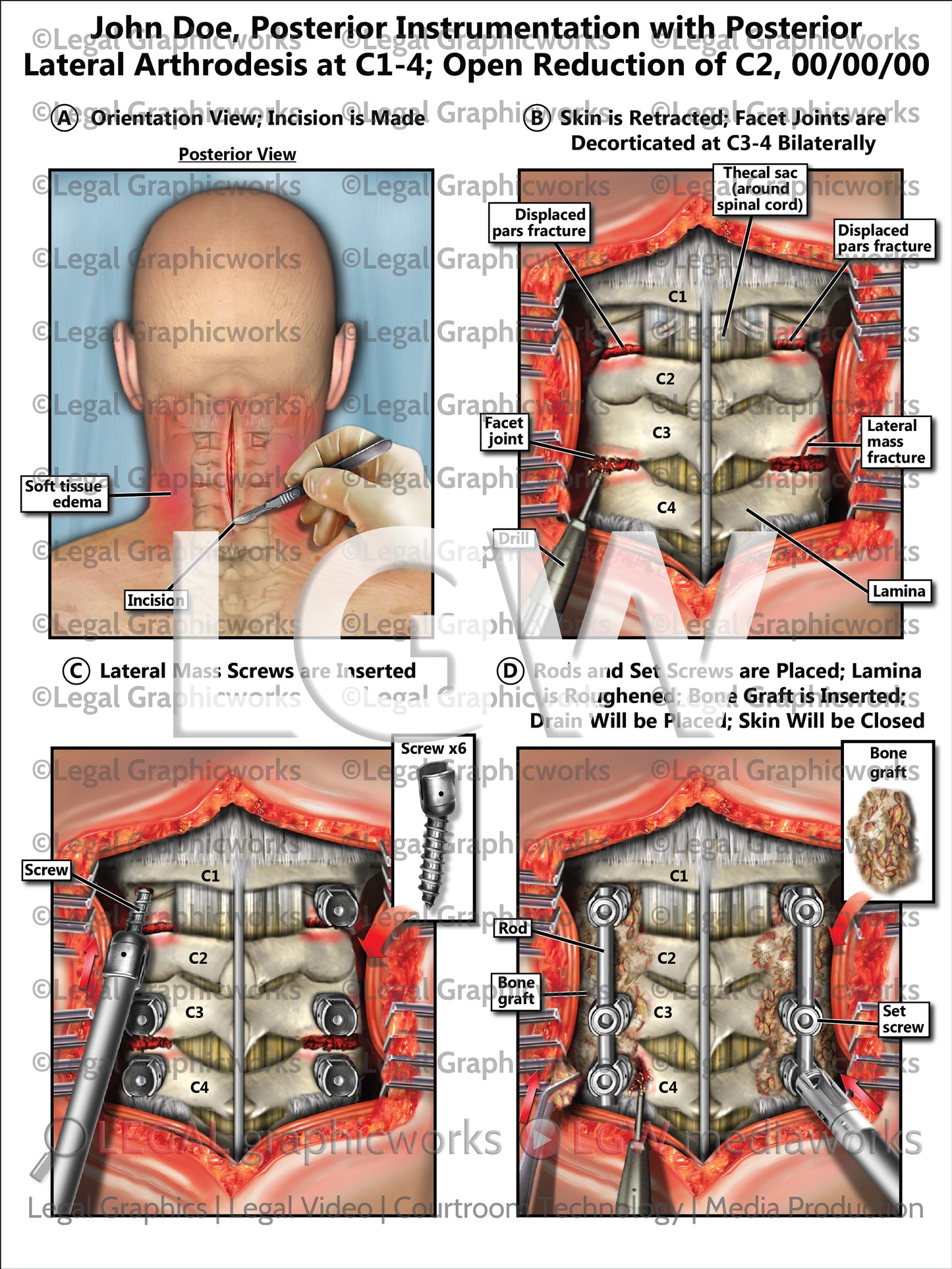Posterior Instrumentation with Posterior Lateral Arthrodesis at C1-4; Open Reduction of C2