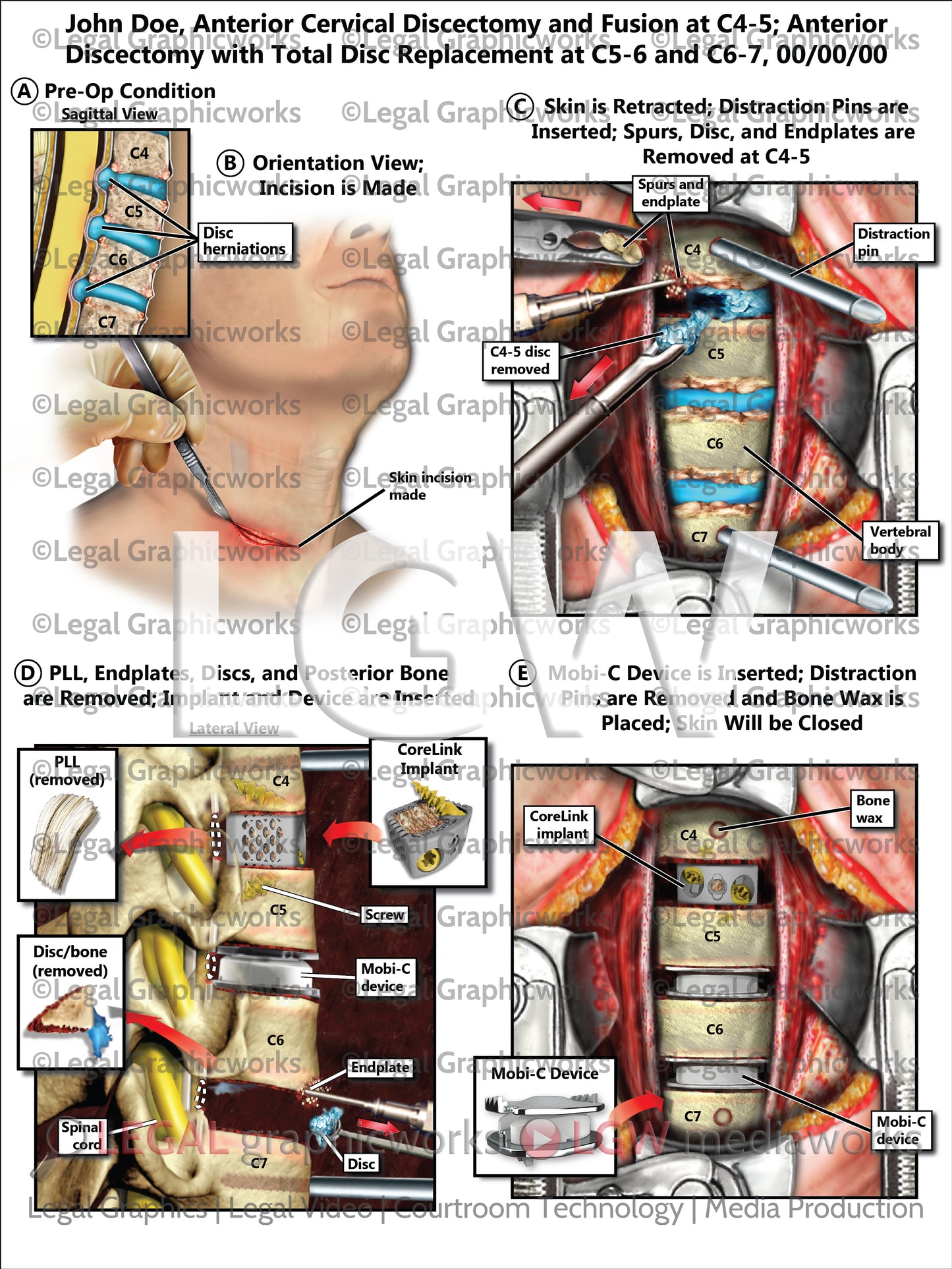 Anterior Cervical Discectomy and Fusion at C4-5; Anterior Discectomy with Total Disc Replacement at C5-6 and C6-7