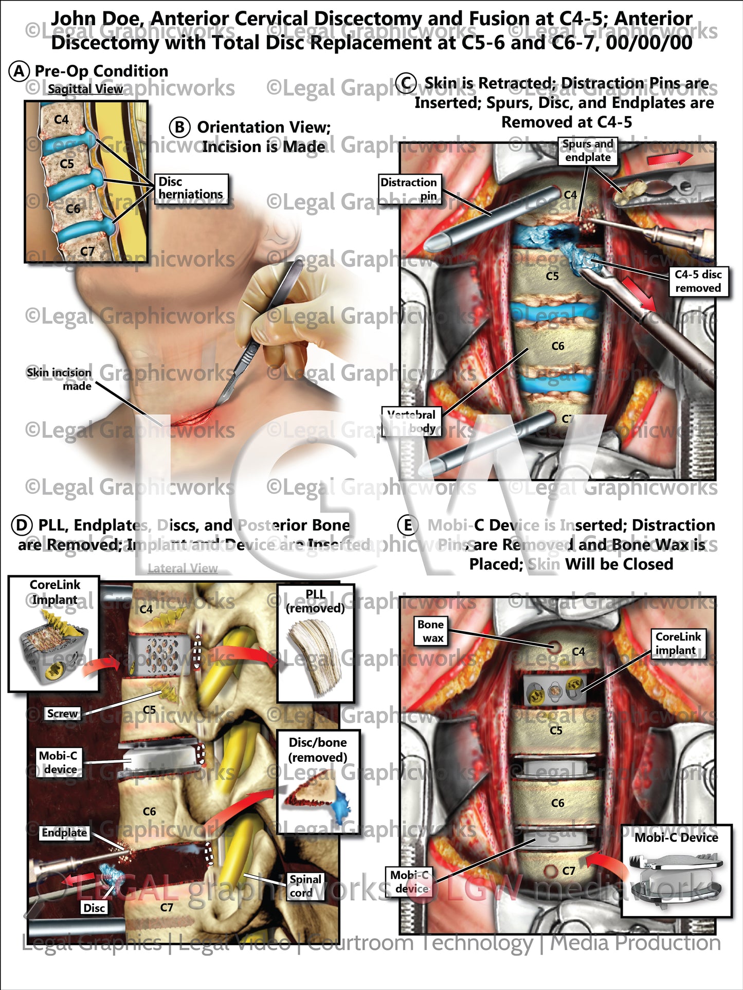 Anterior Cervical Discectomy and Fusion at C4-5; Anterior Discectomy with Total Disc Replacement at C5-6 and C6-7