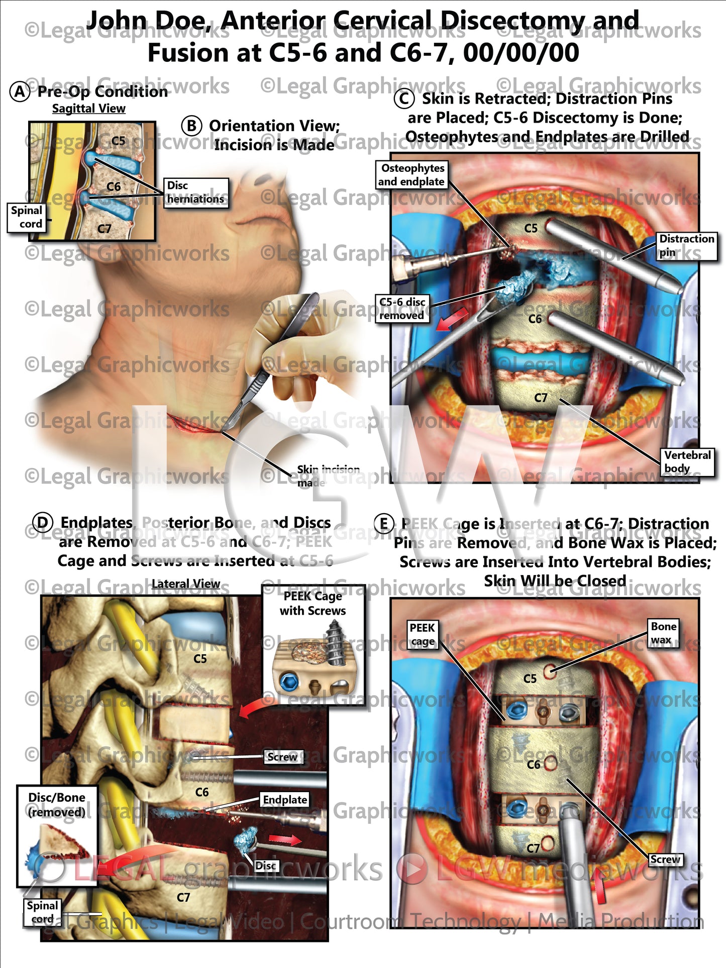 Anterior Cervical Discectomy and Fusion at C5-6 and C6-7