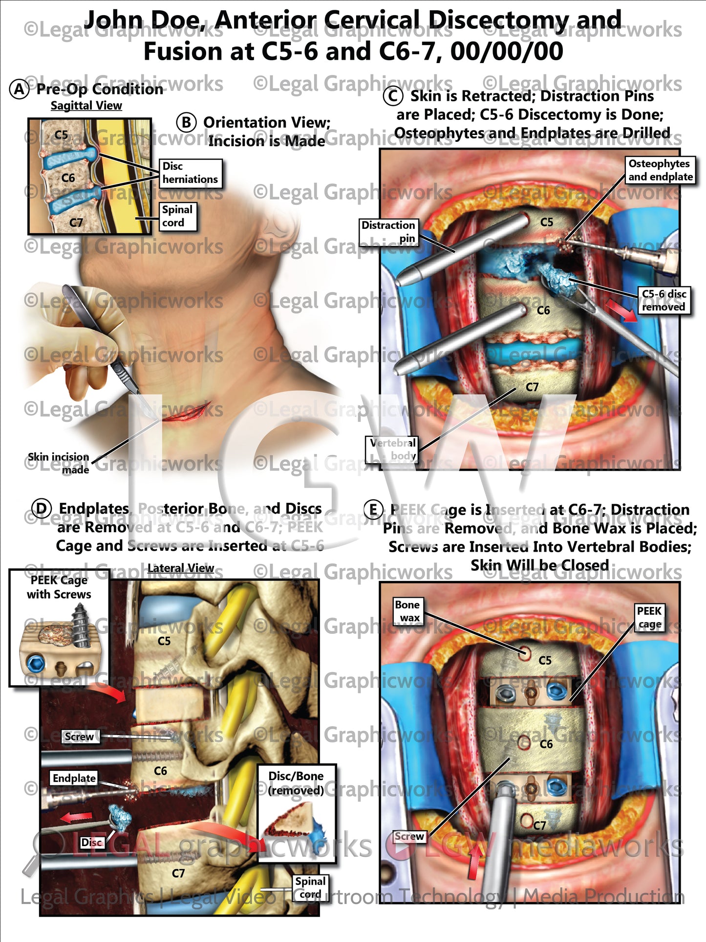 Anterior Cervical Discectomy and Fusion at C5-6 and C6-7