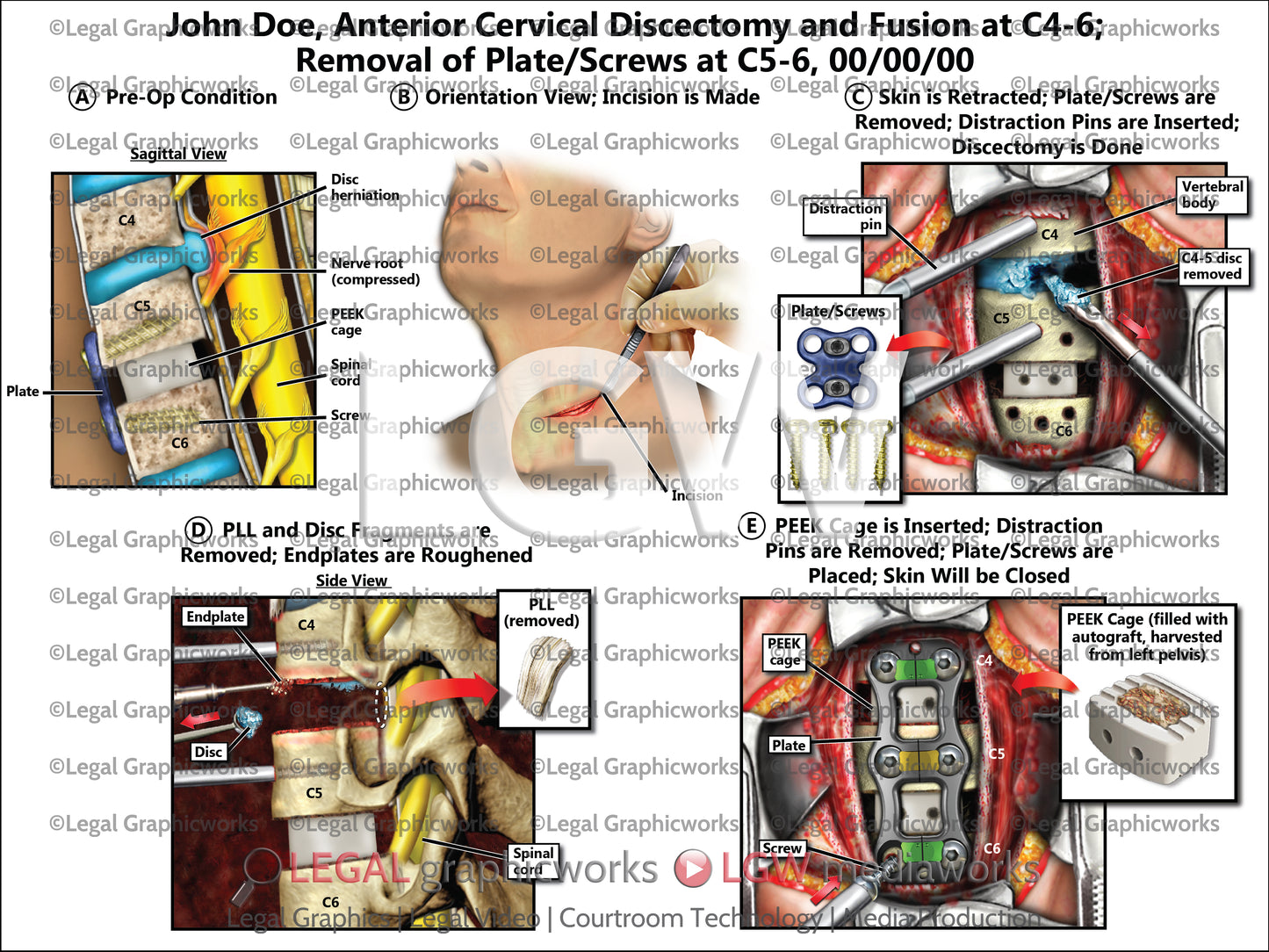 Anterior Cervical Discectomy and Fusion at C4-6; Removal of Plate/Screws at C5-6
