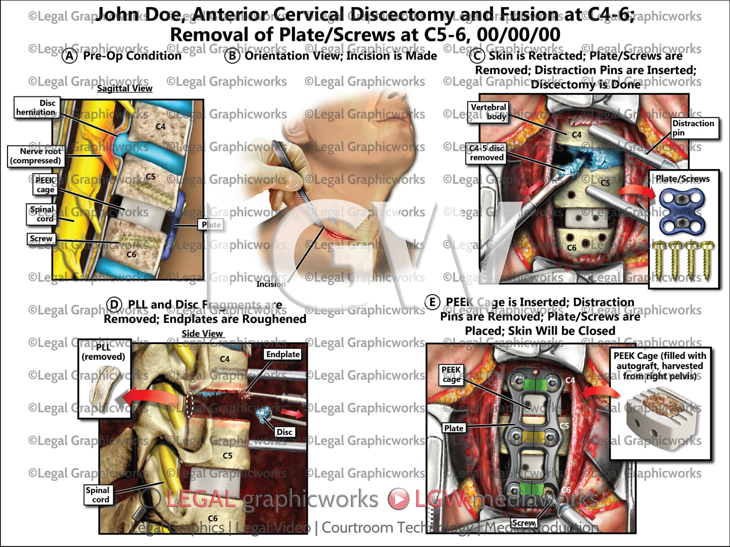 Anterior Cervical Discectomy and Fusion at C4-6; Removal of Plate/Screws at C5-6