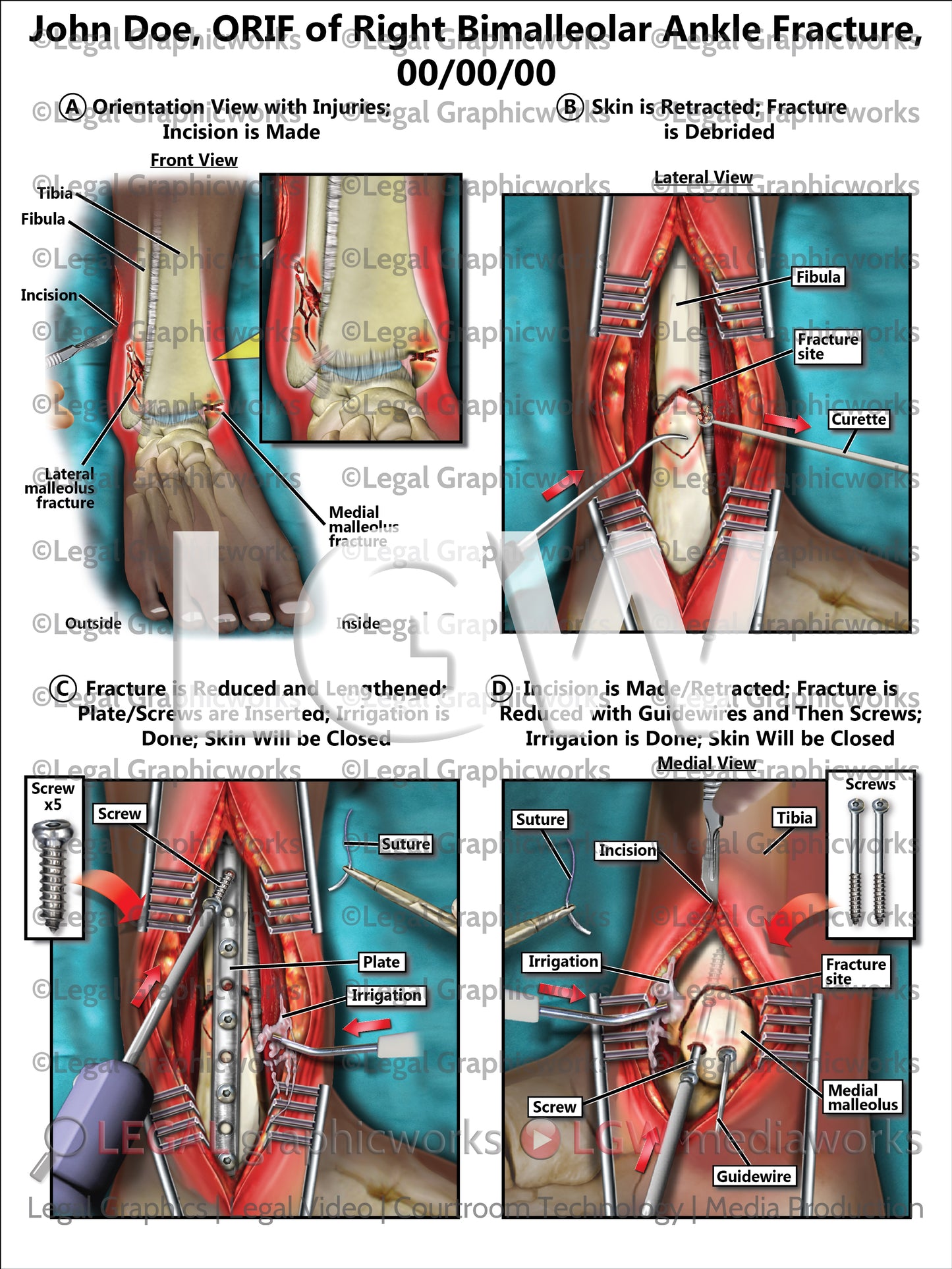 ORIF of Right Bimalleolar Ankle Fracture