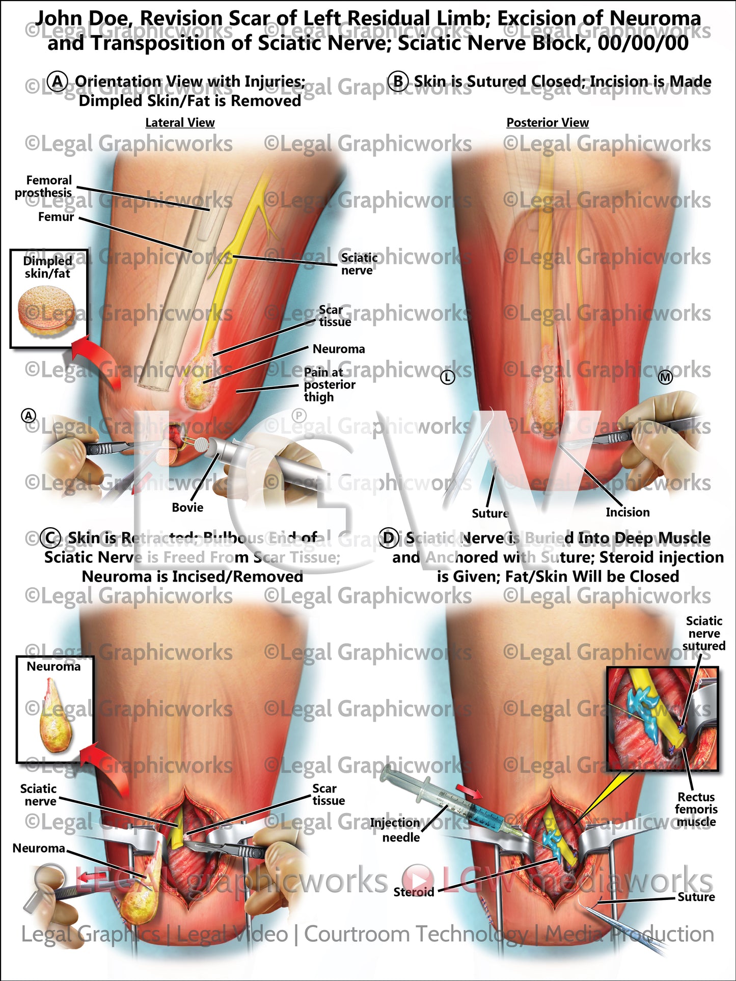 Revision Scar of Left Residual Limb; Excision of Neuroma and Transposition of Sciatic Nerve; Sciatic Nerve Block