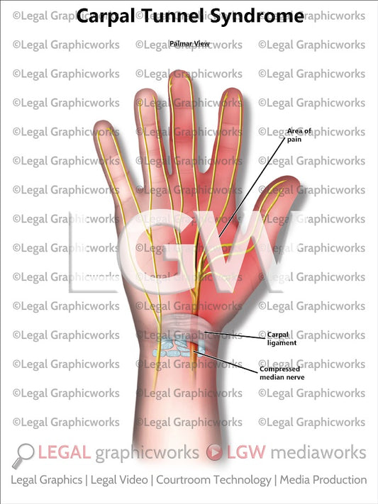 Carpal Tunnel Syndrome