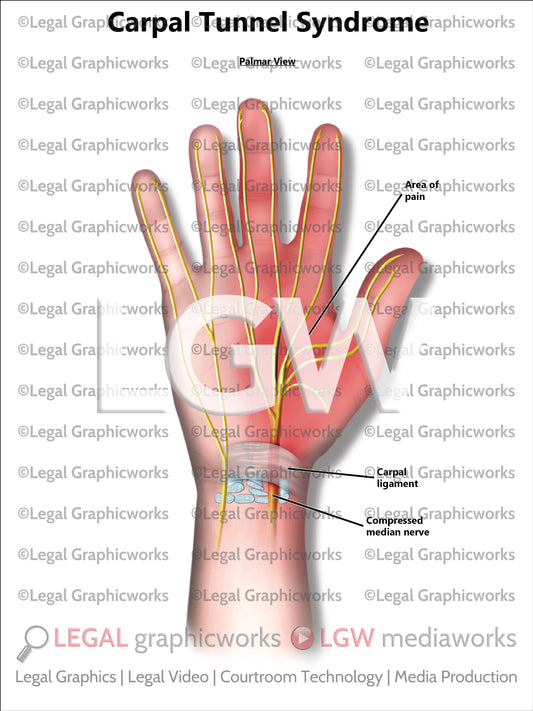 Carpal Tunnel Syndrome