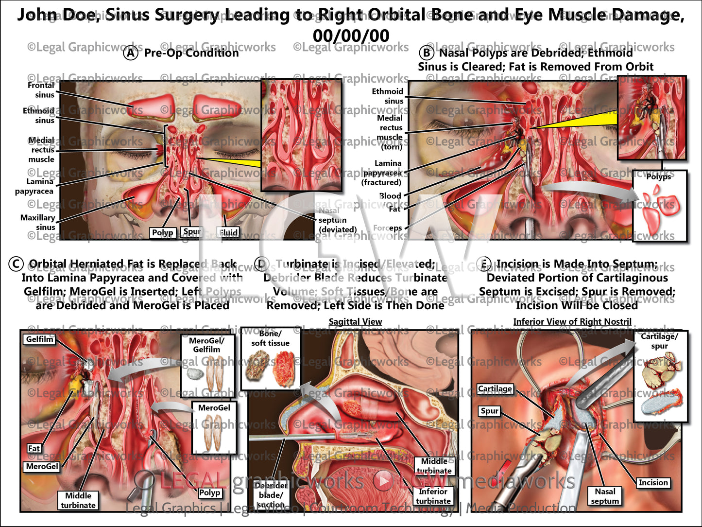 Sinus Surgery Leading to Right Orbital Bone and Eye Muscle Damage