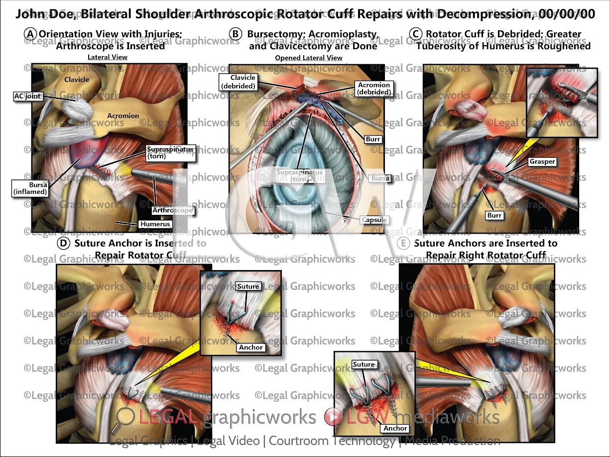 Bilateral Shoulder Arthroscopic Rotator Cuff Repairs with Decompression