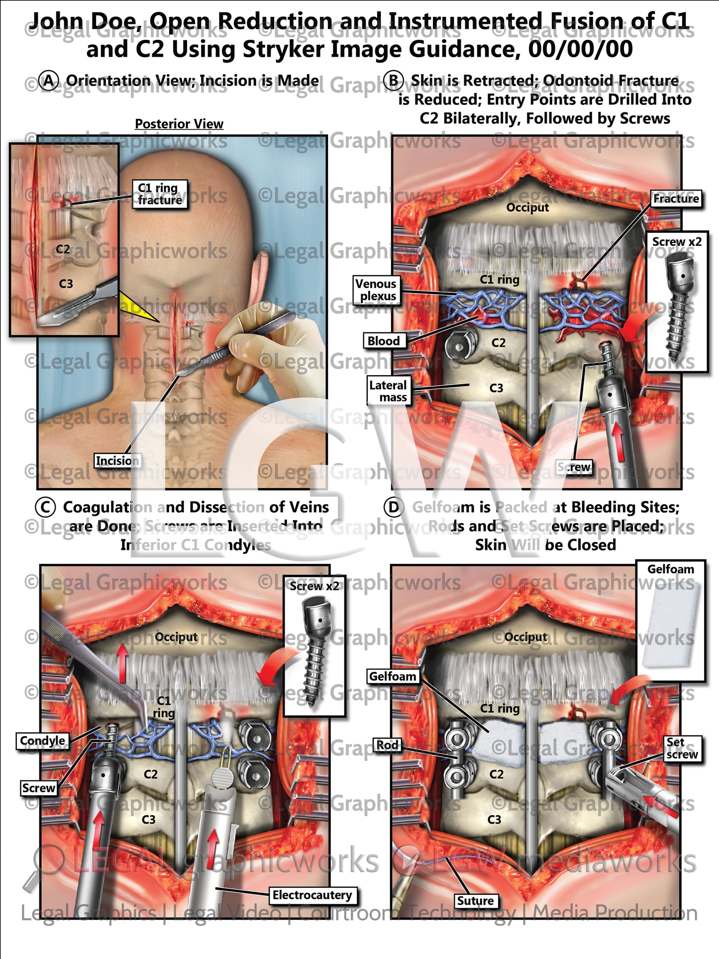 Open Reduction and Instrumented Fusion of C1 and C2 Using Stryker Image Guidance