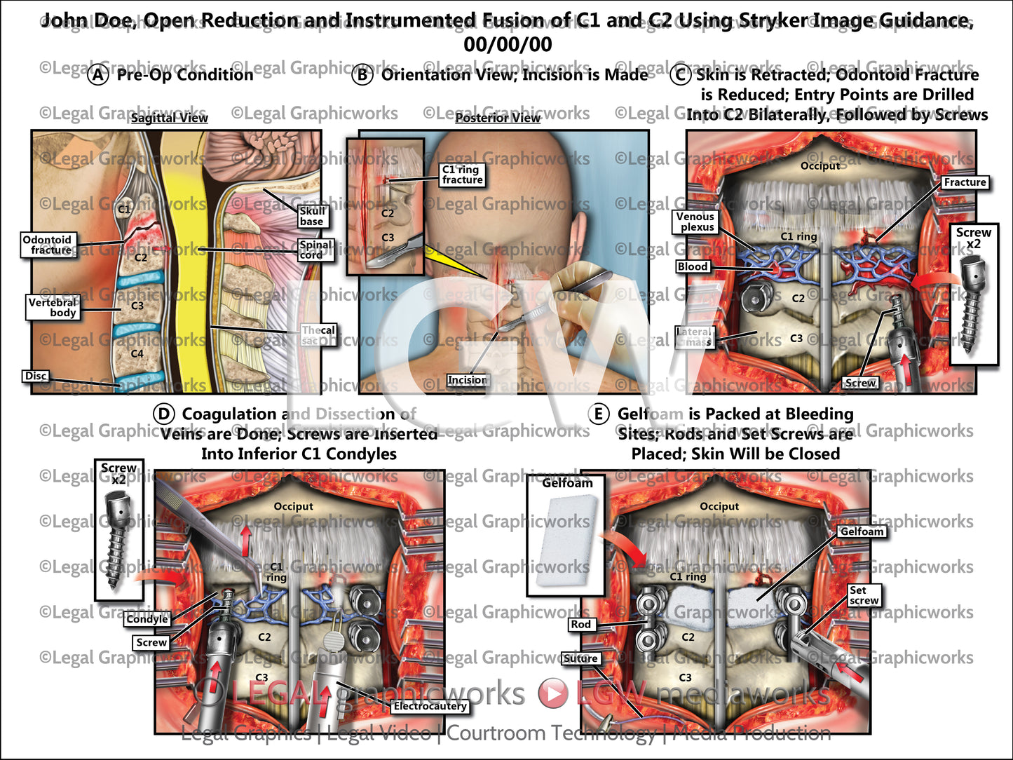 Open Reduction and Instrumented Fusion of C1 and C2 Using Stryker Image Guidance