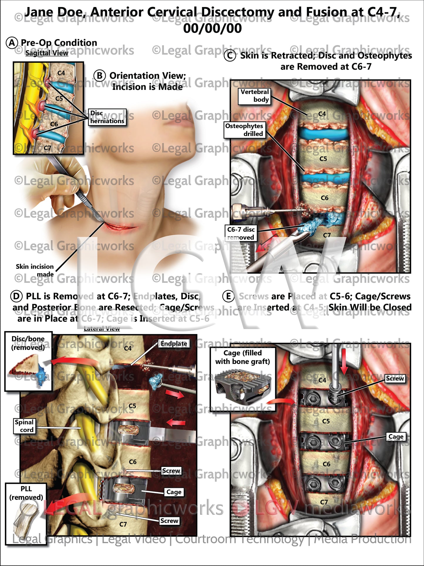 Anterior Cervical Discectomy and Fusion at C4-7