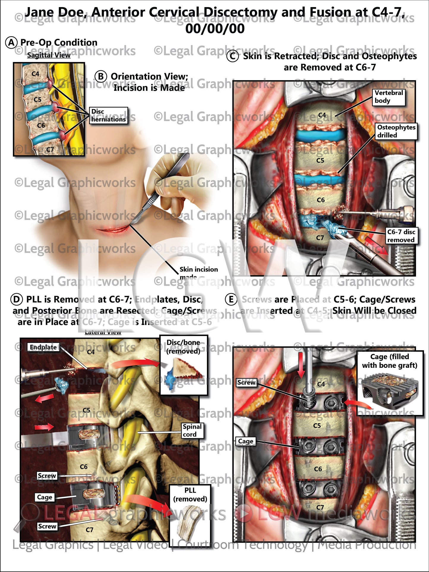Anterior Cervical Discectomy and Fusion at C4-7