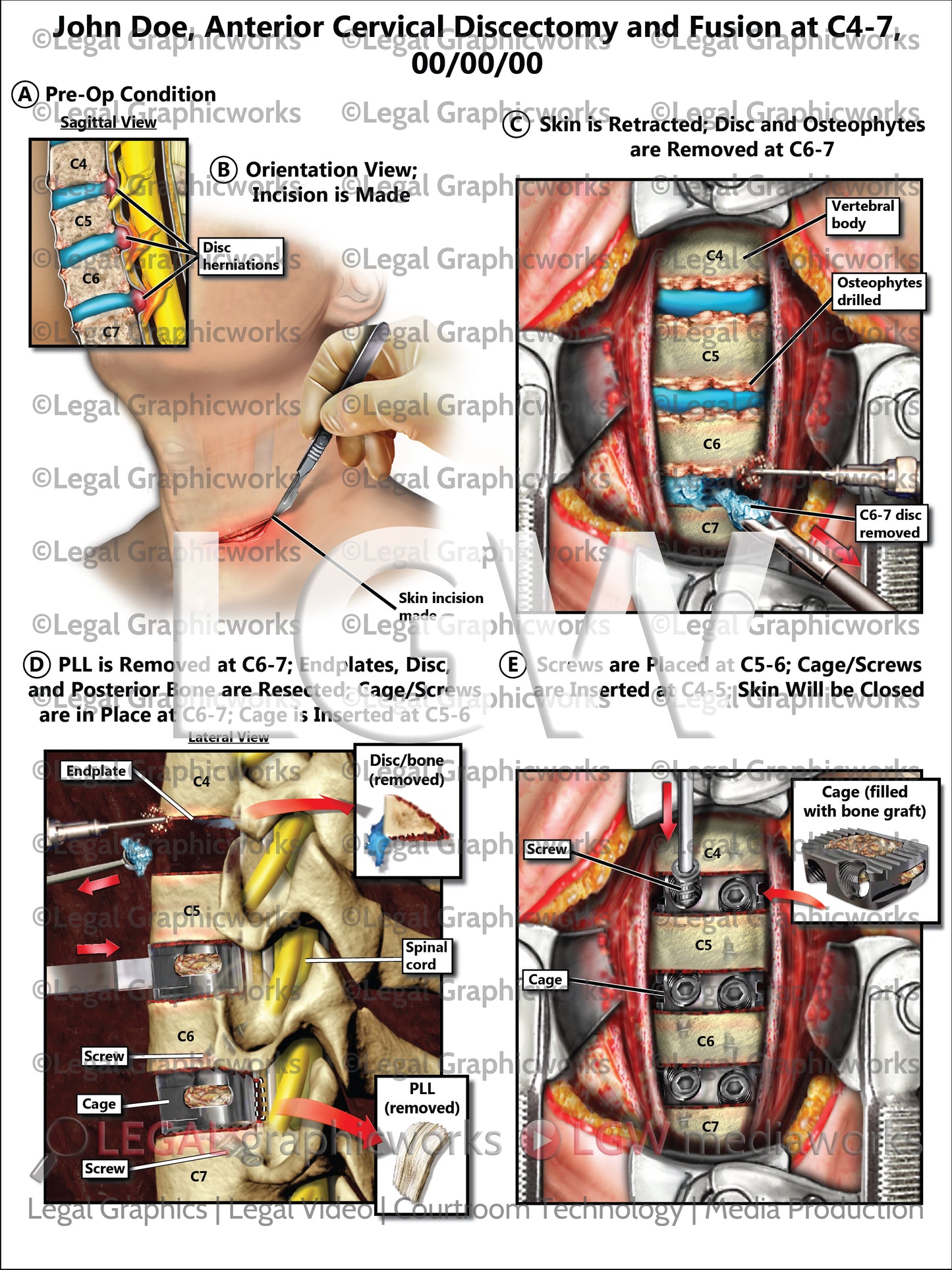 Anterior Cervical Discectomy and Fusion at C4-7