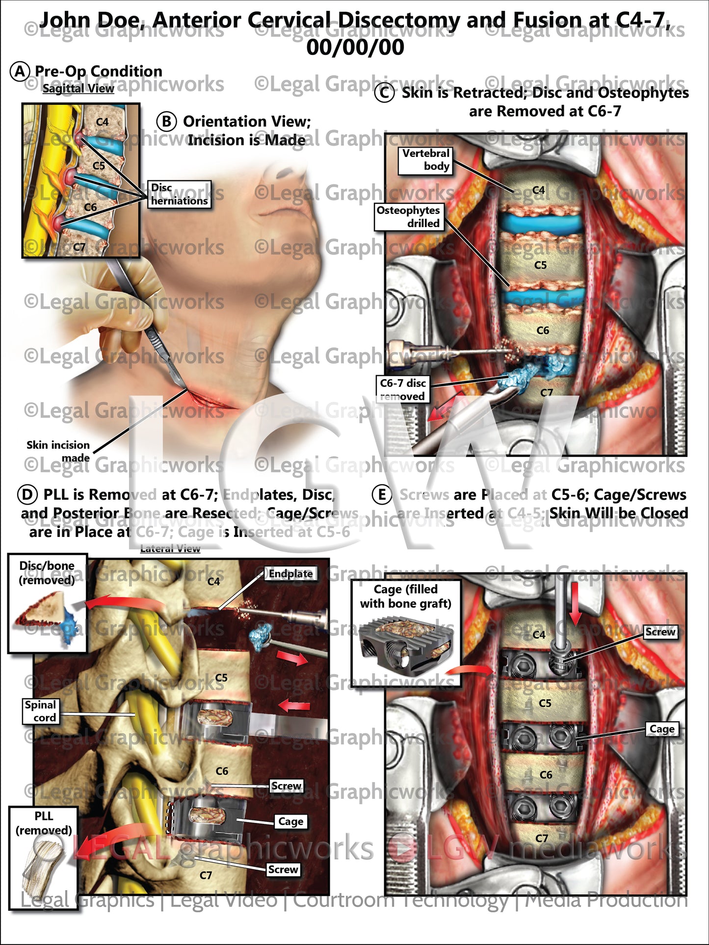 Anterior Cervical Discectomy and Fusion at C4-7