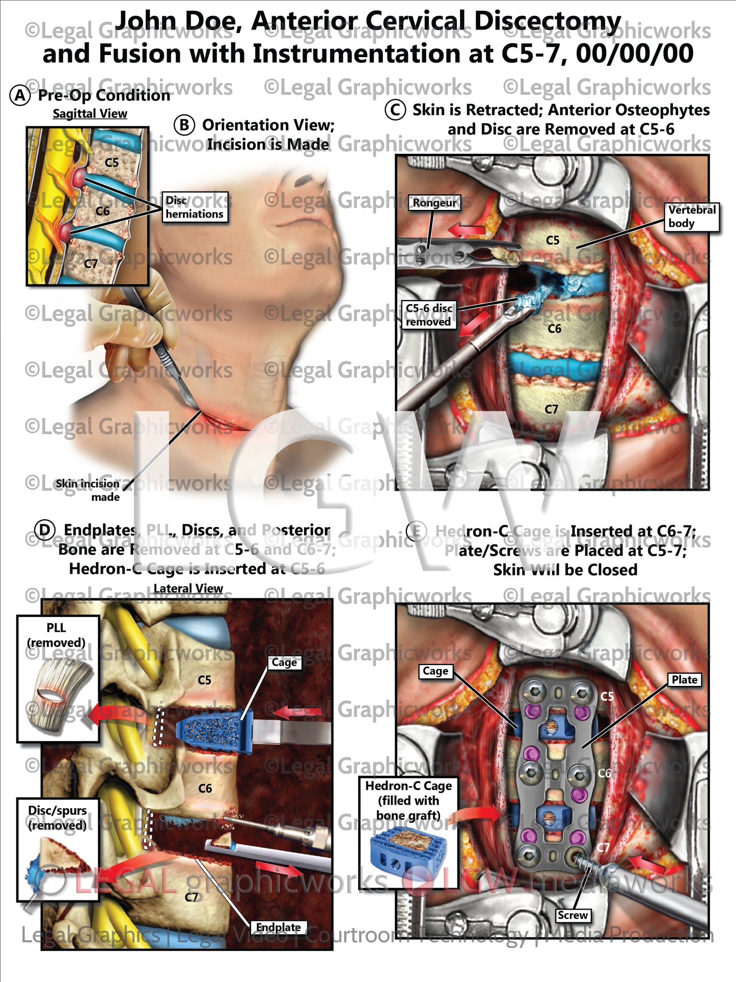 Anterior Cervical Discectomy and Fusion with Instrumentation at C5-7