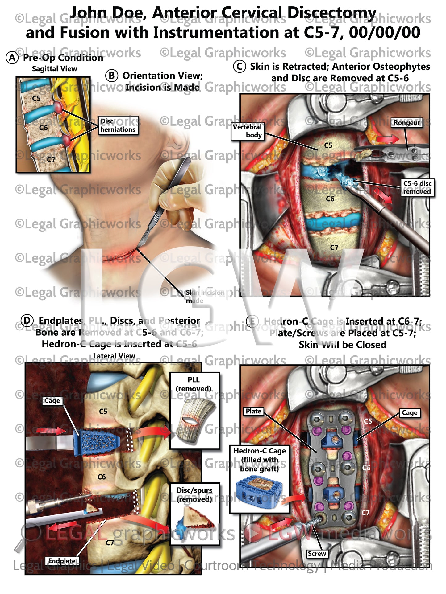 Anterior Cervical Discectomy and Fusion with Instrumentation at C5-7