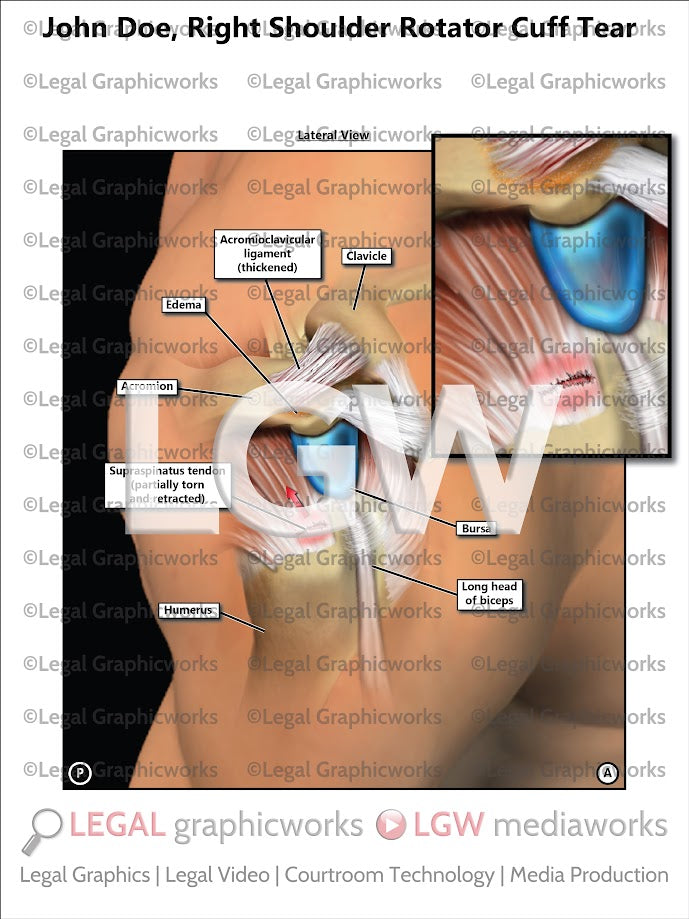 Right Shoulder Rotator Cuff Tear