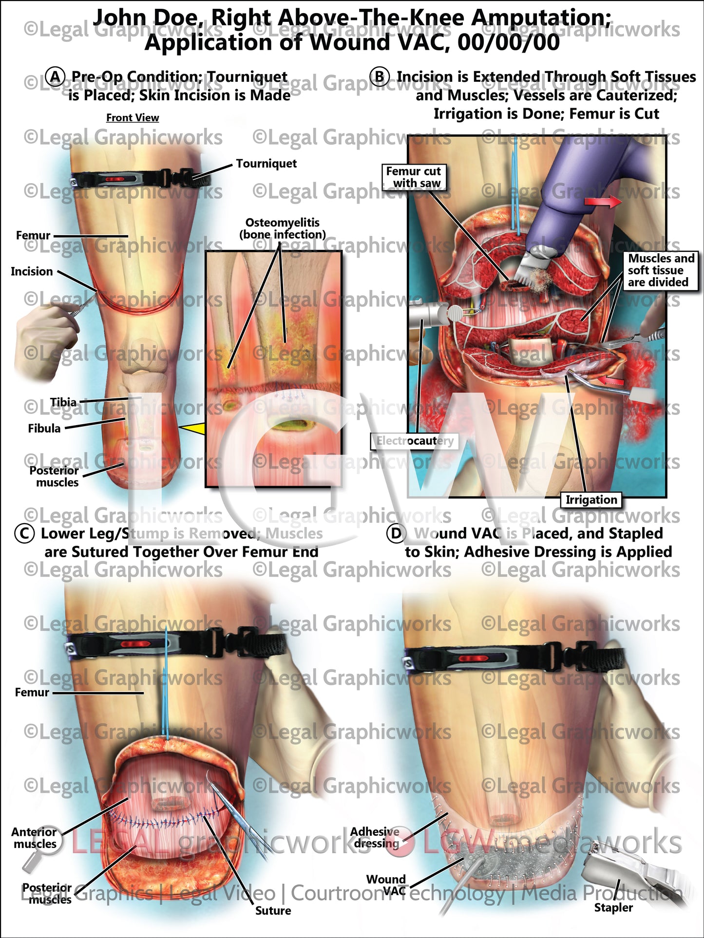 Right Above-the-Knee Amputation; Application of Wound VAC