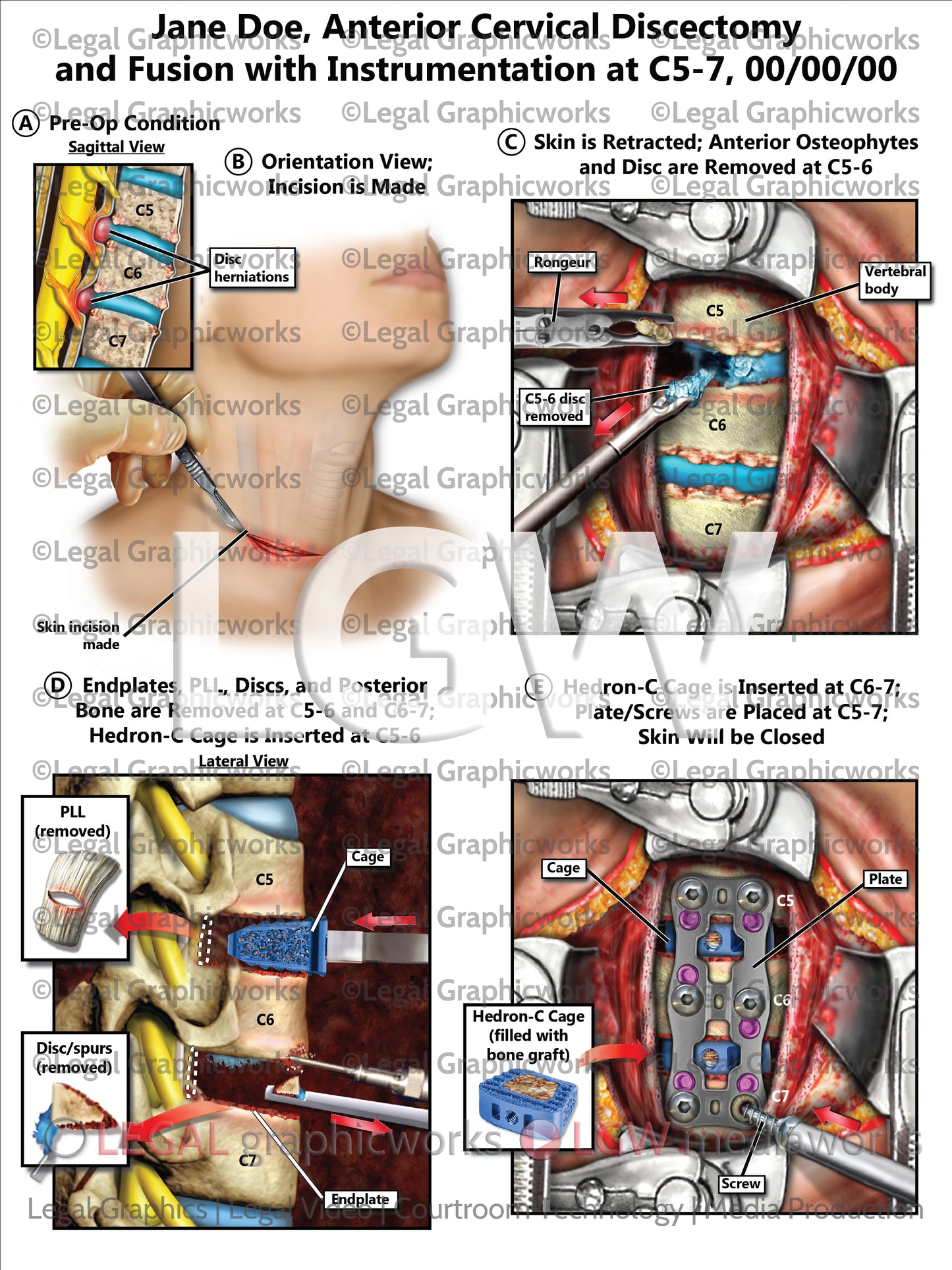 Anterior Cervical Discectomy and Fusion with Instrumentation at C5-7