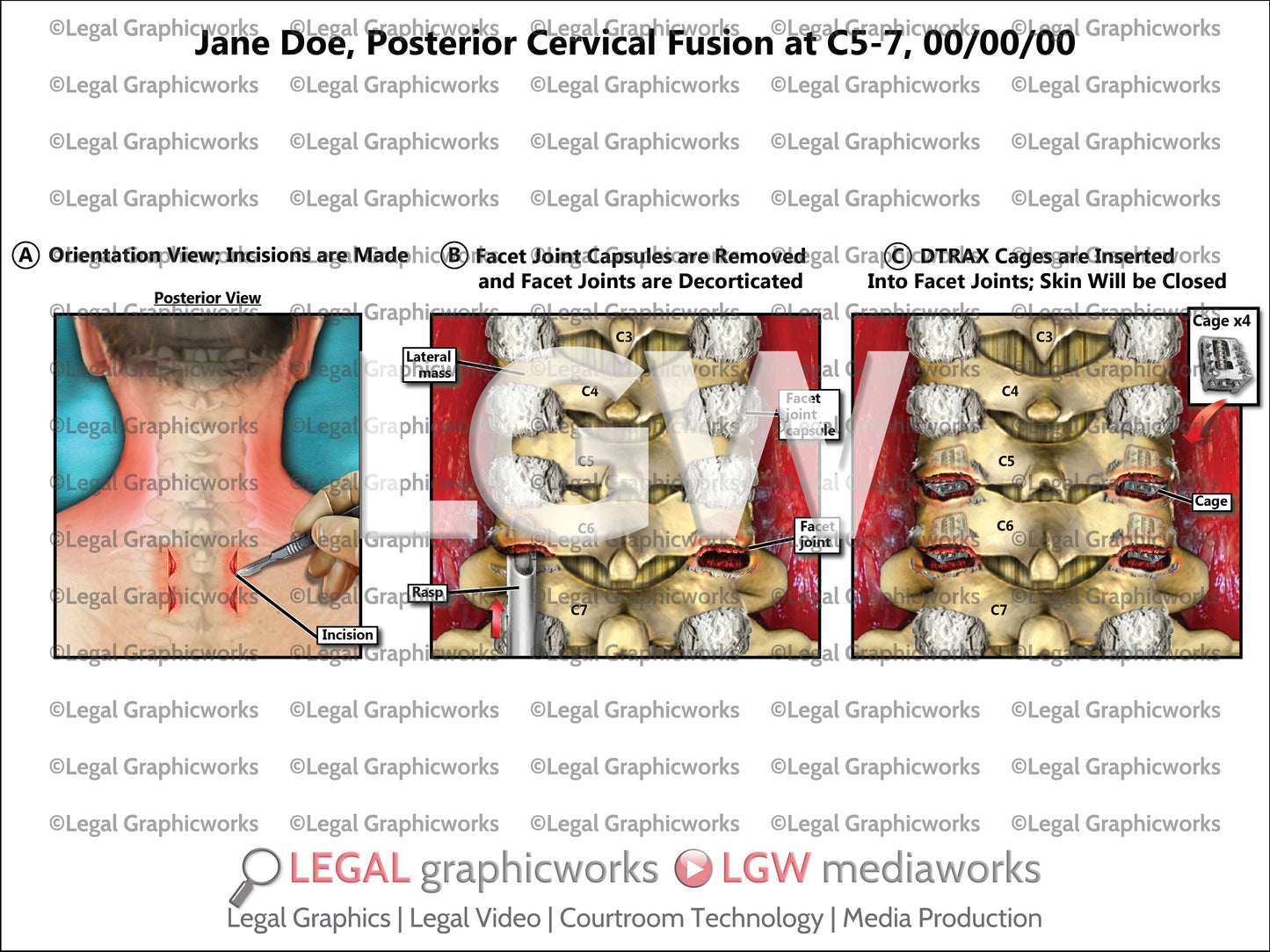 Posterior Cervical Fusion at C5-7
