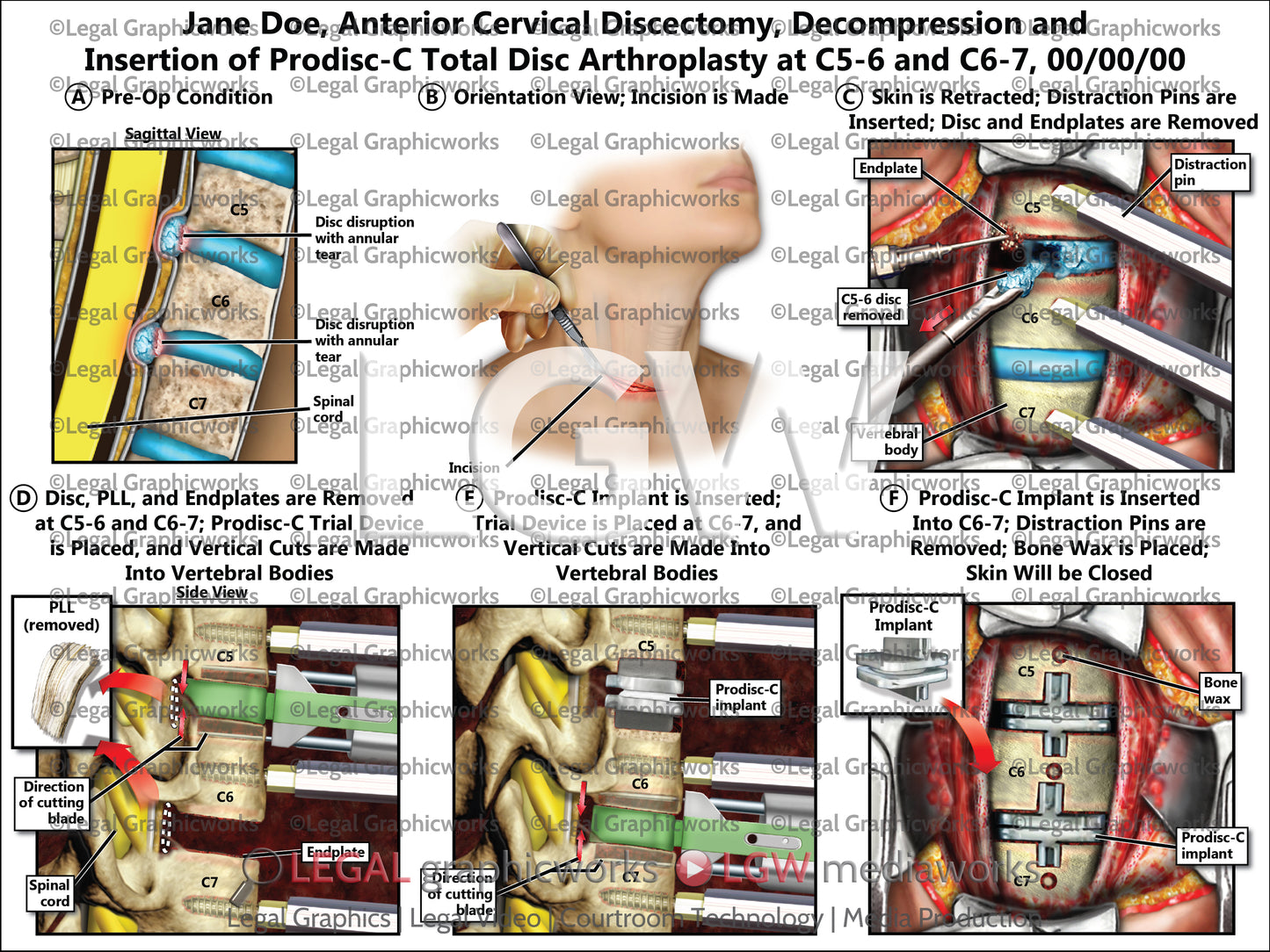 Anterior Cervical Discectomy, Decompression and Insertion of Prodisc-C Total Disc Arthroplasty at C5-6 and C6-7