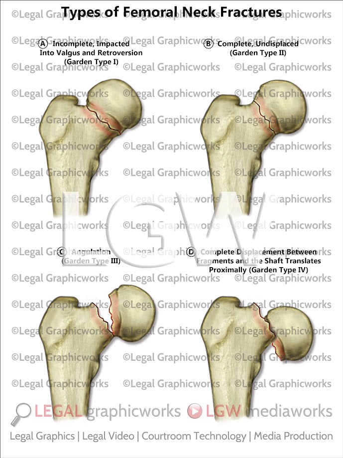 Types of Femoral Neck Fractures