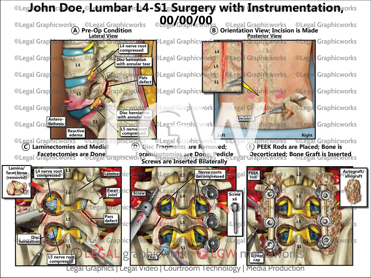 Lumbar L4-S1 Surgery with Instrumentation